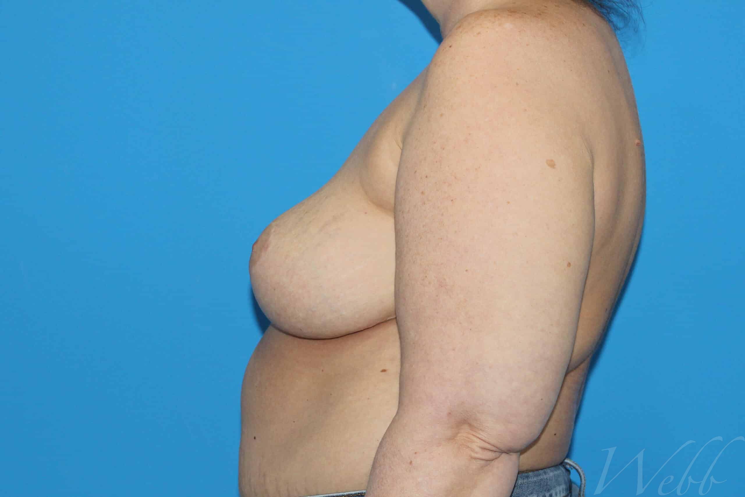 implant removal patient