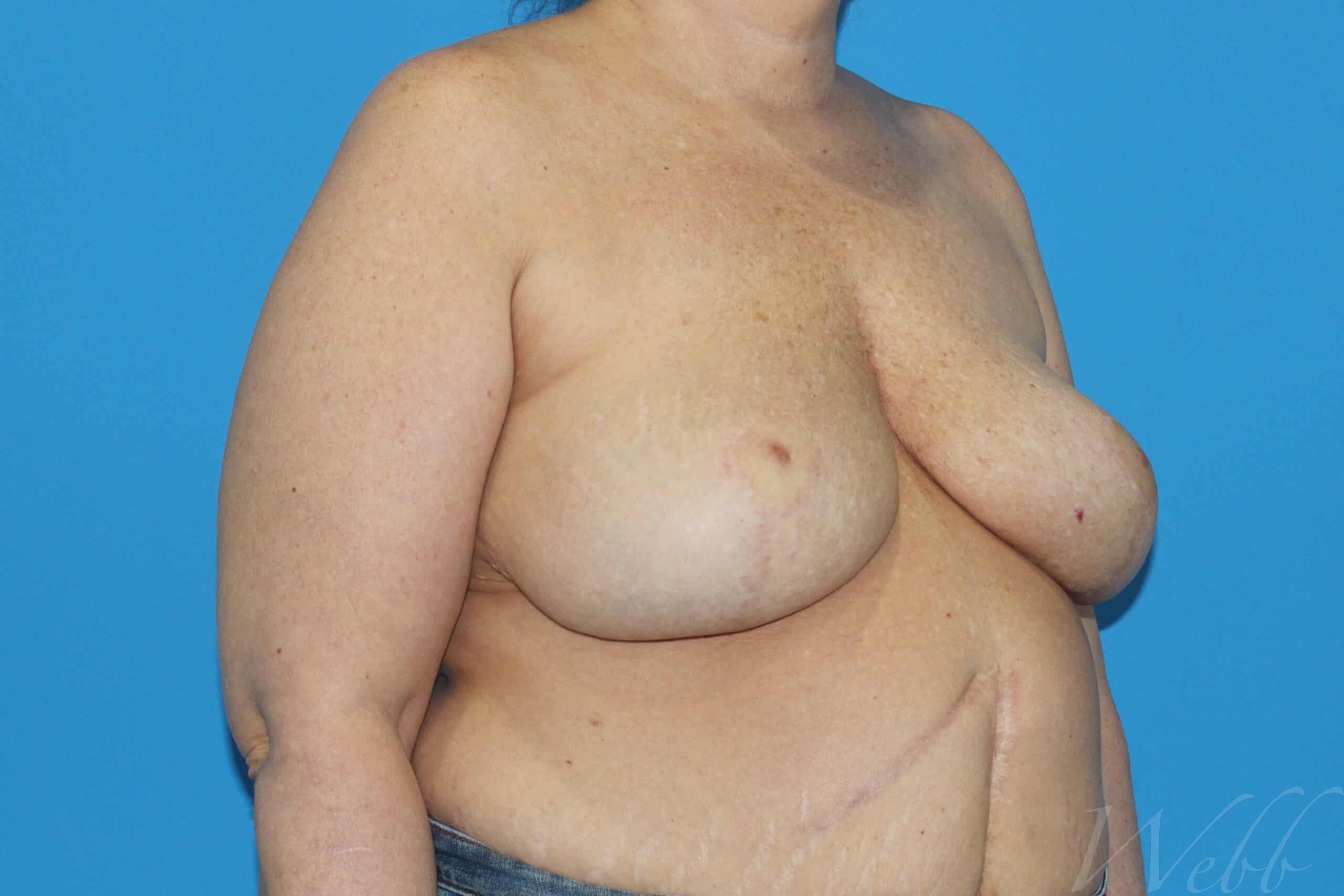 implant removal patient