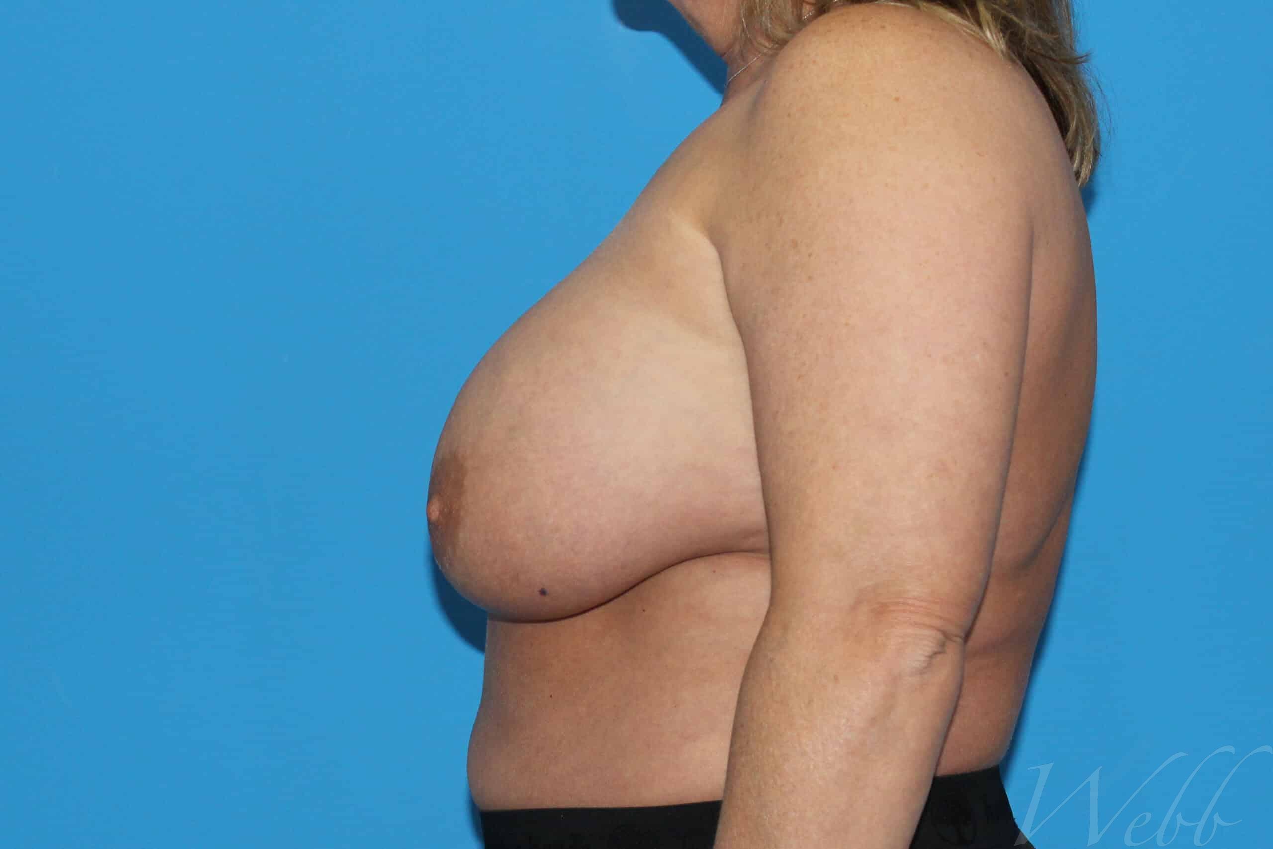 implant removal patient