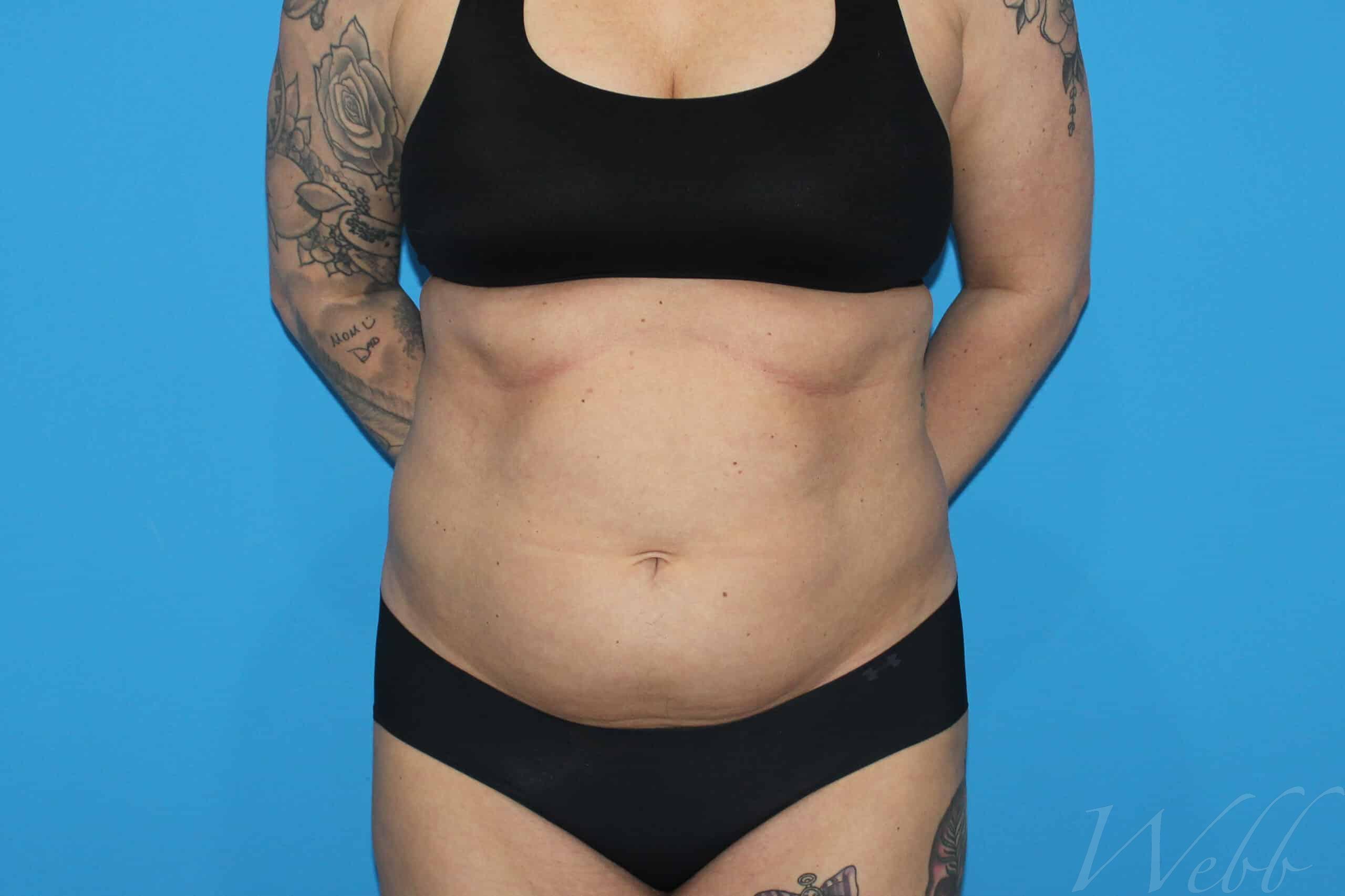 liposuction patient
