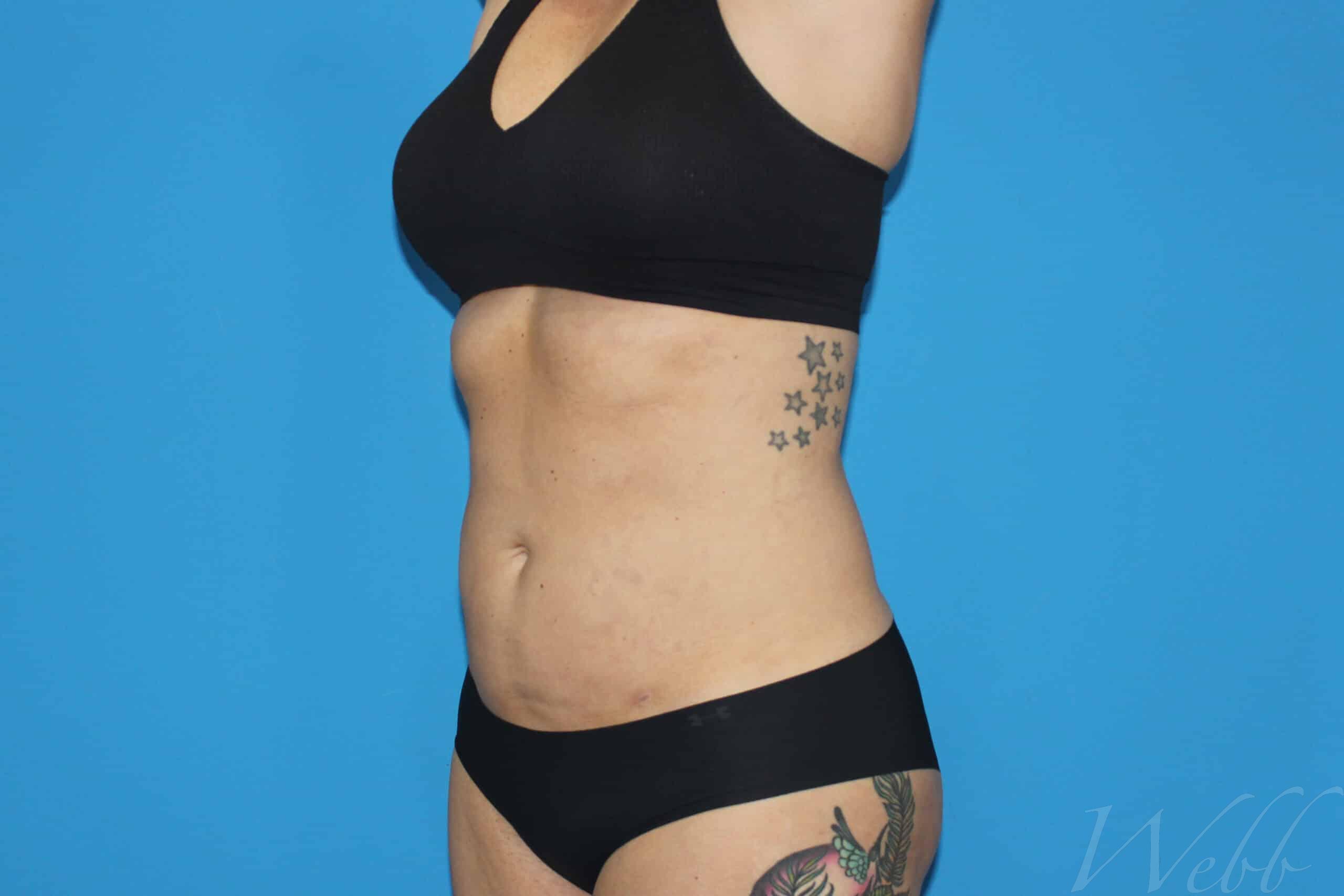 liposuction patient
