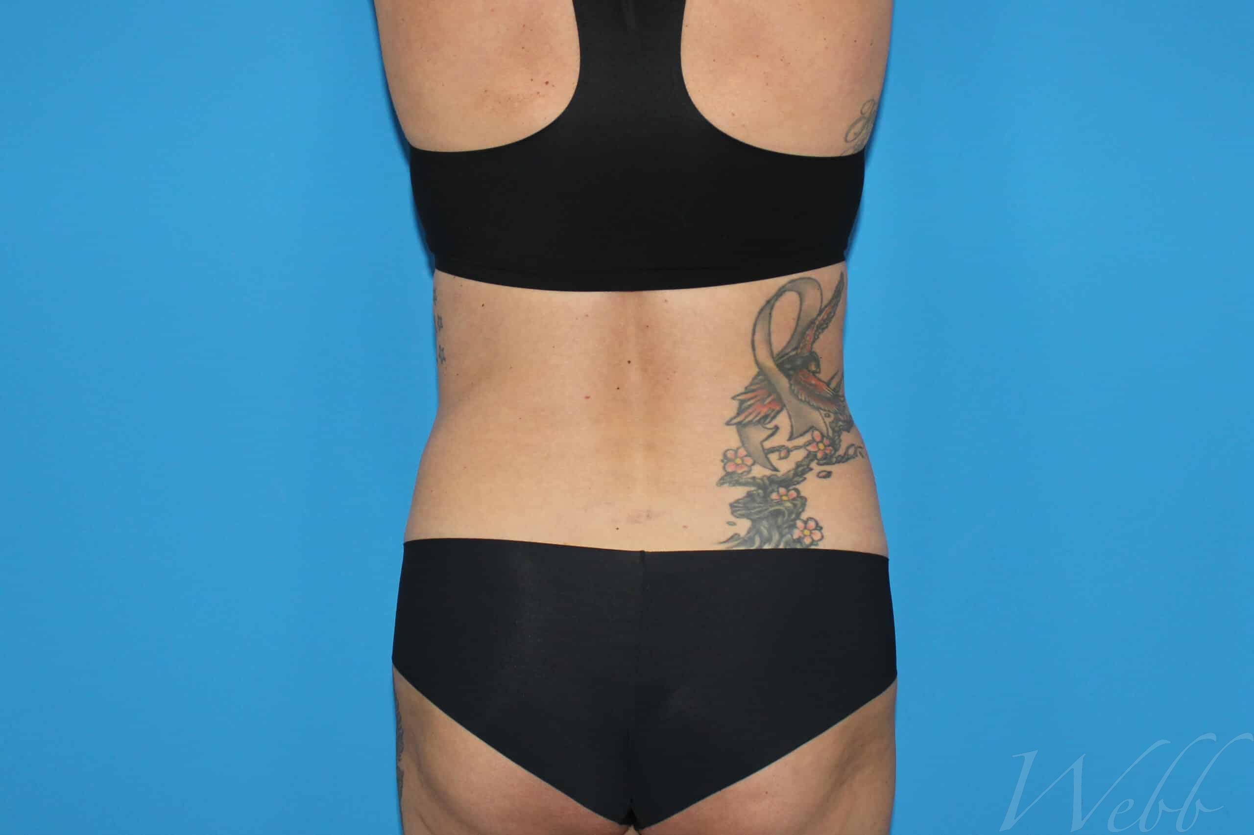 liposuction patient