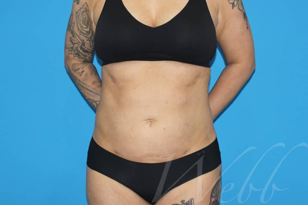 Liposuction
