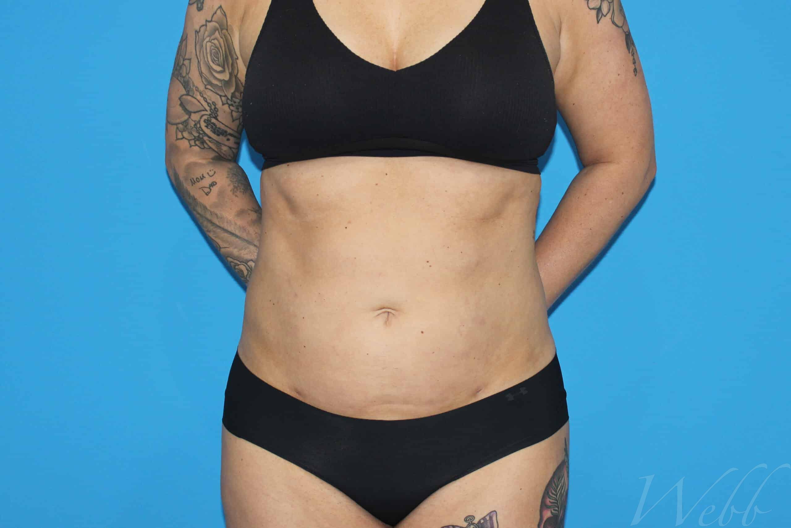 liposuction patient