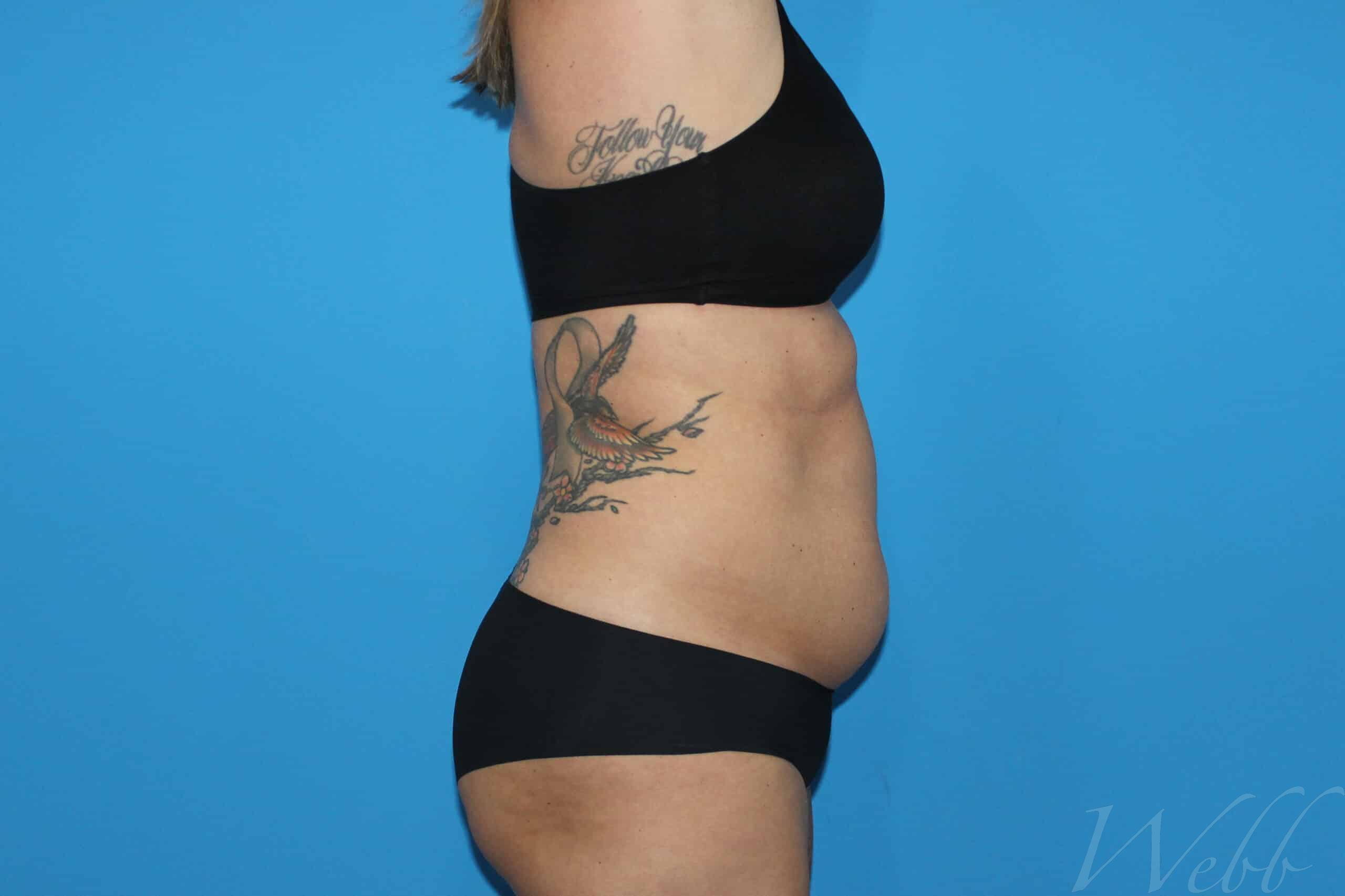 liposuction patient