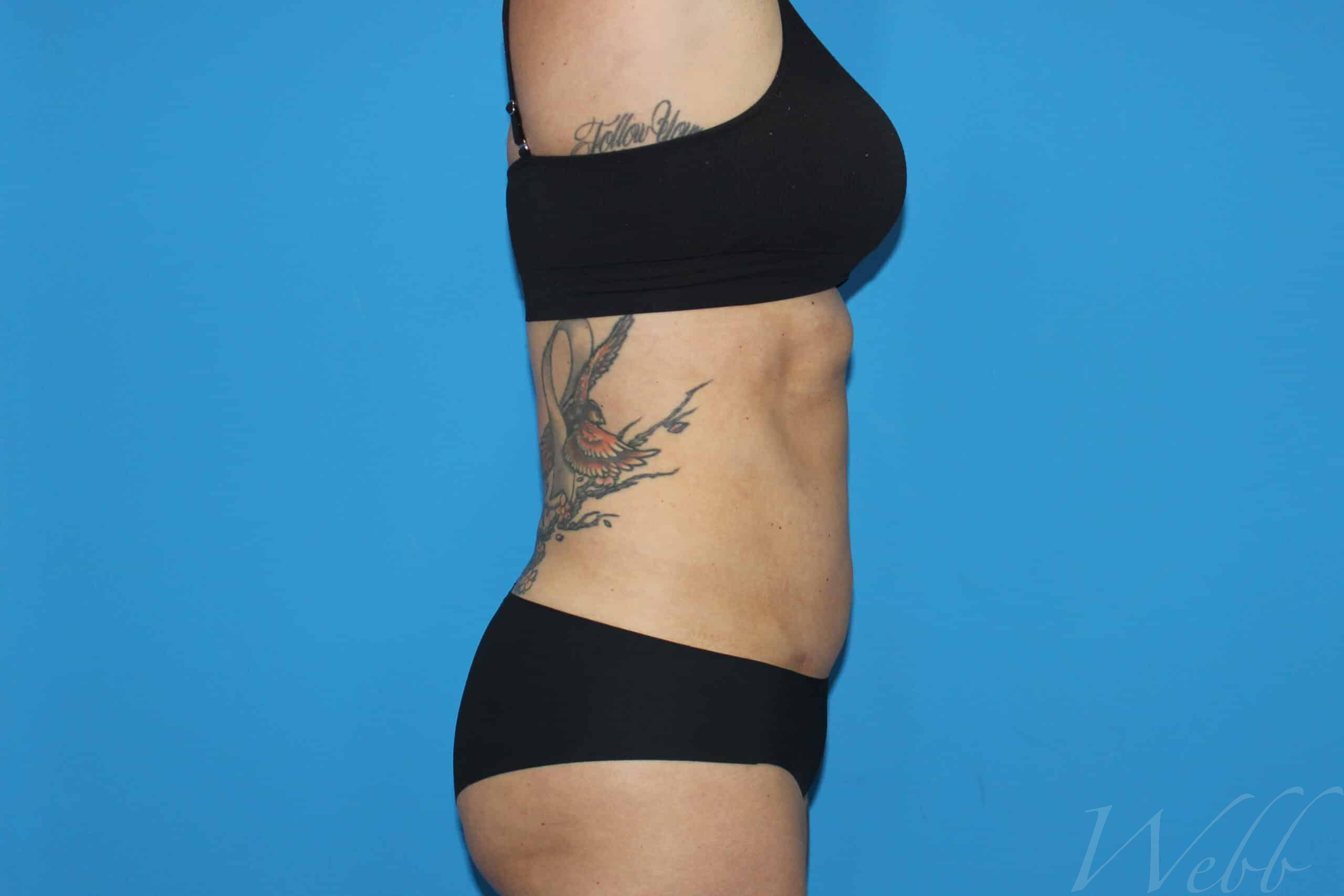 liposuction patient
