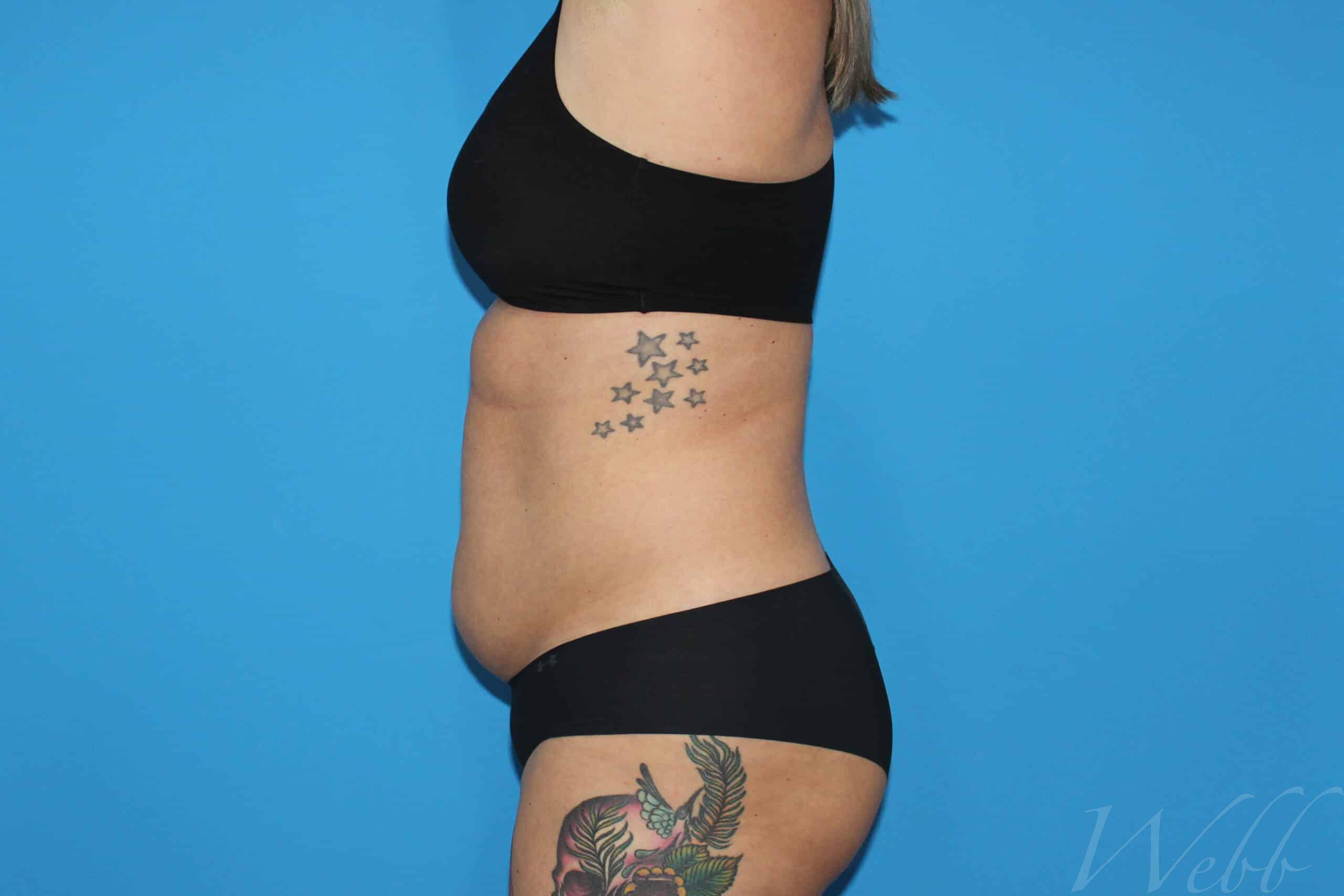 liposuction patient
