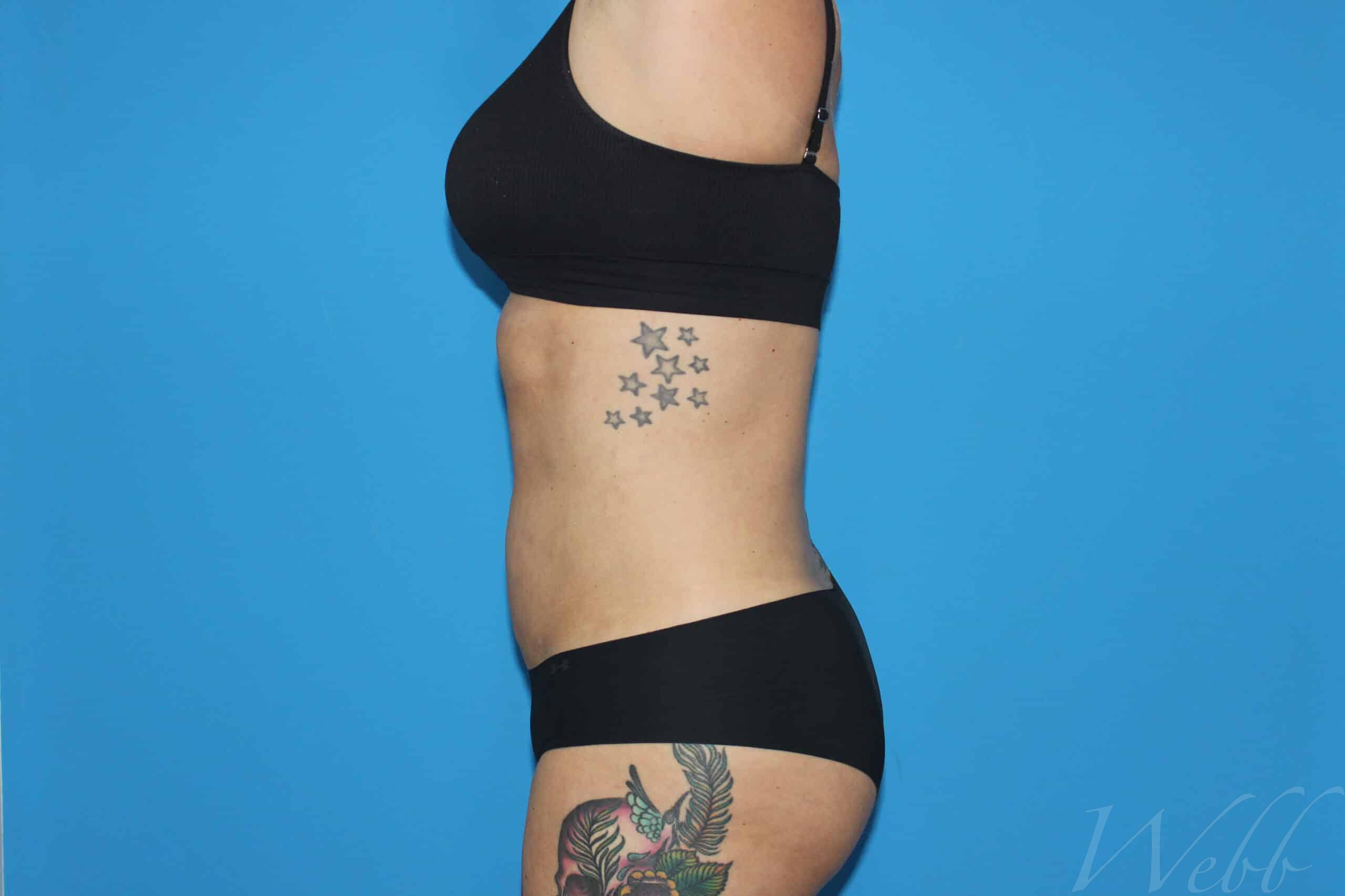 liposuction patient