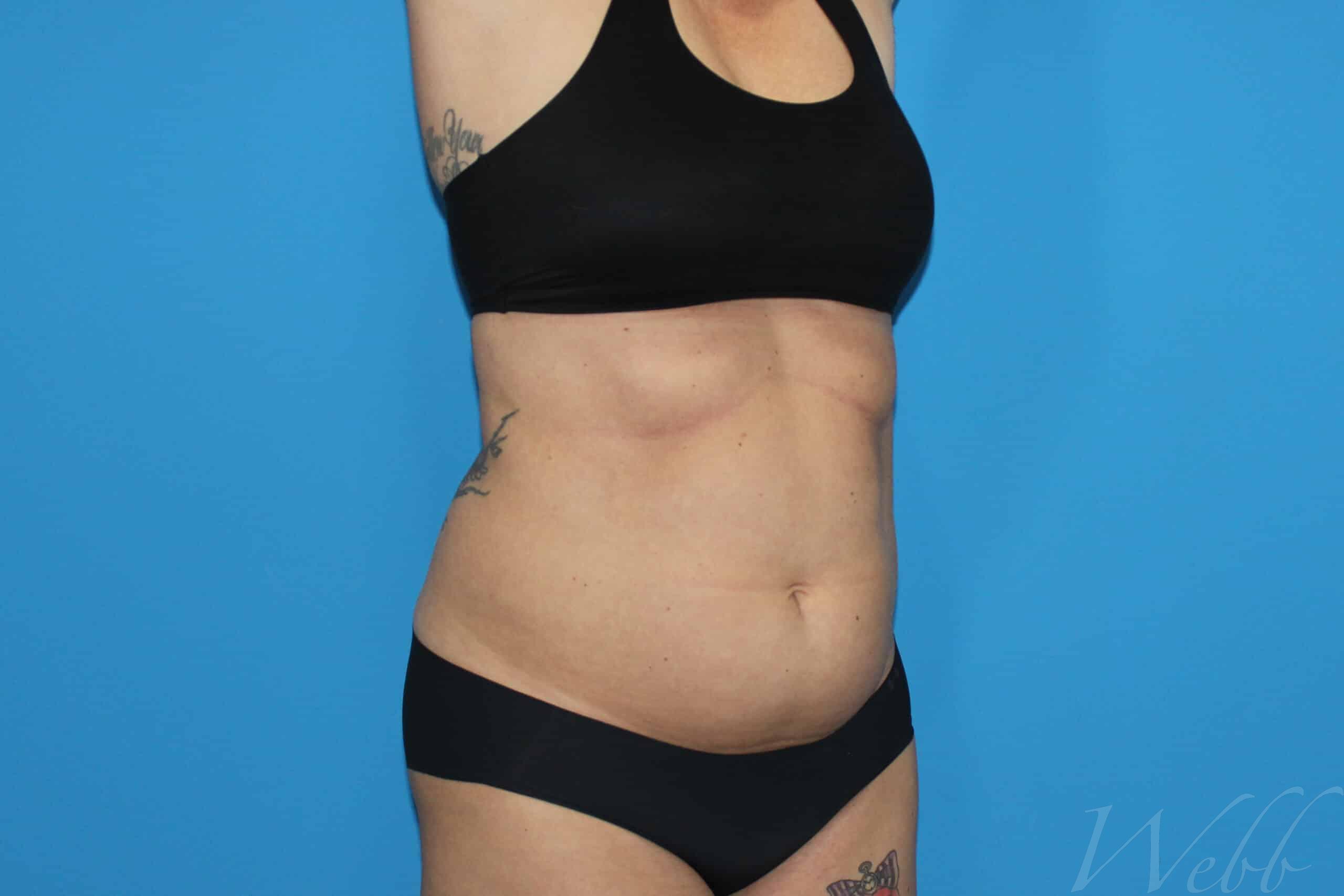 liposuction patient