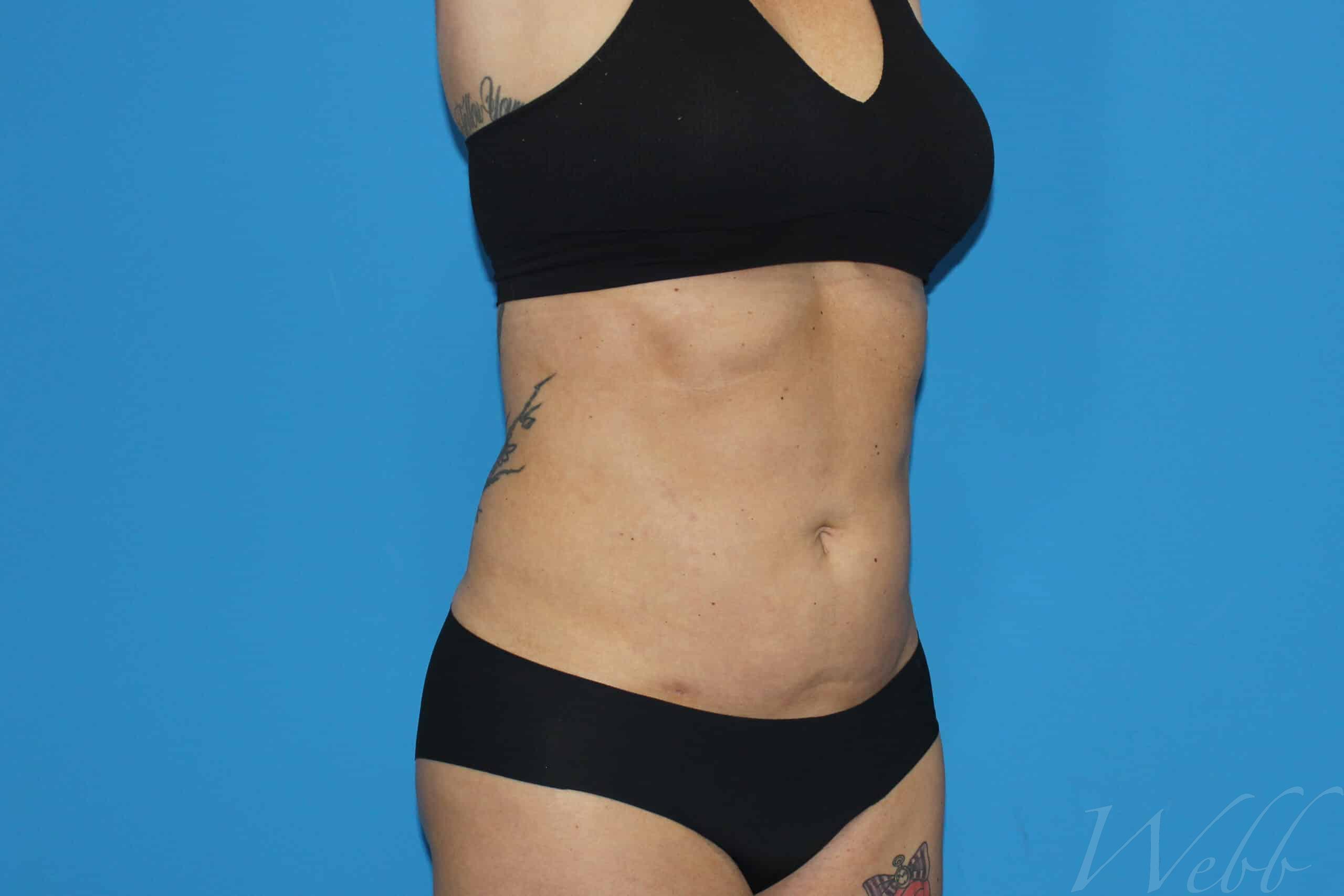 liposuction patient