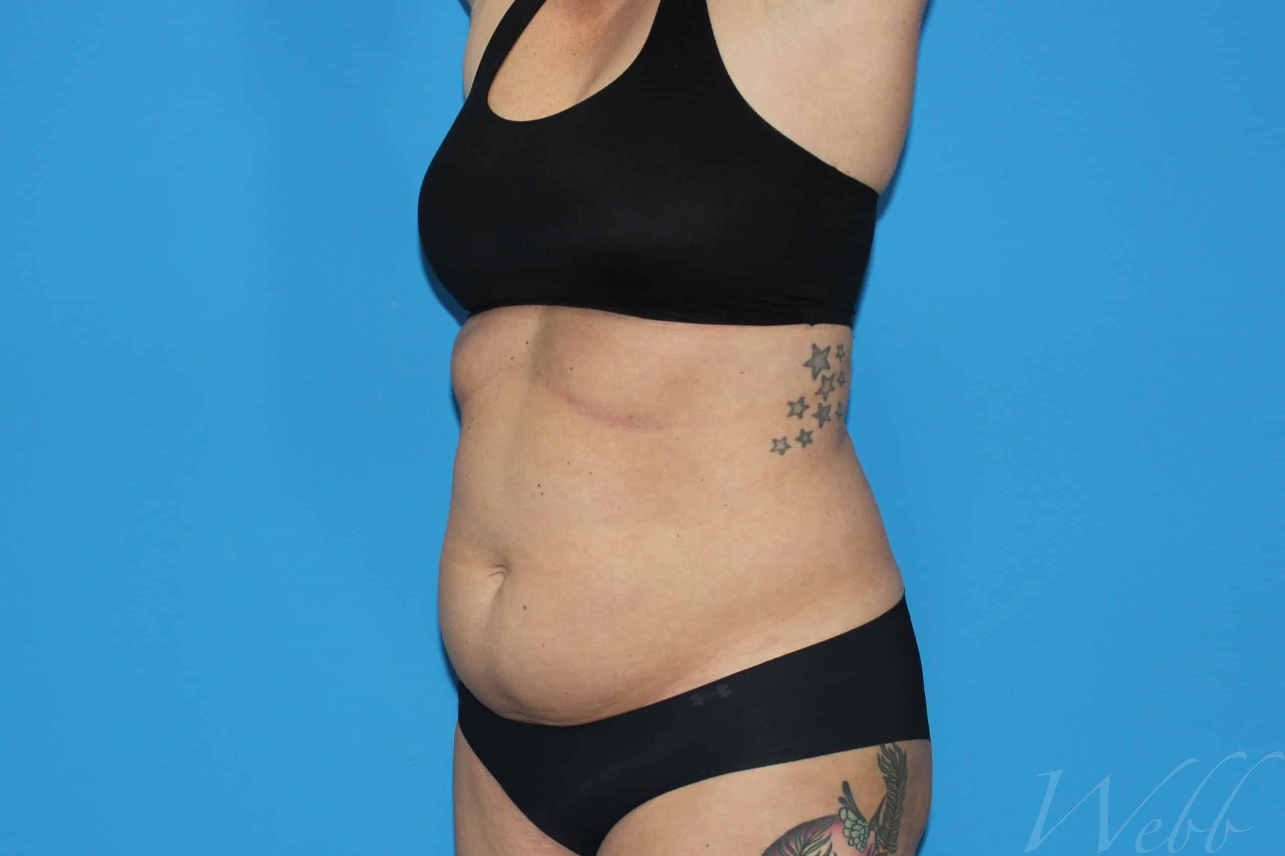 liposuction patient