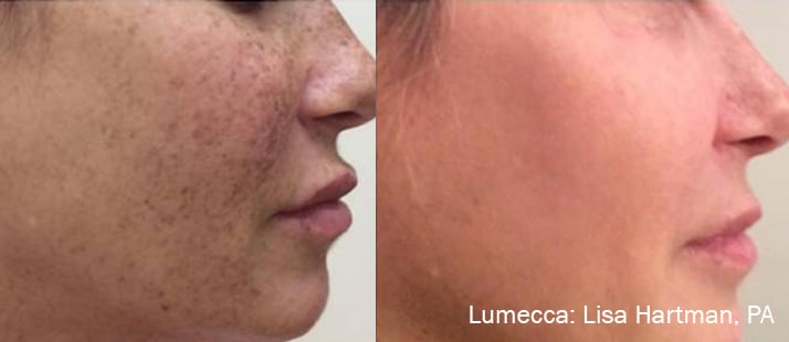 lumecca-before-after-dr-l-hartman-preview-1