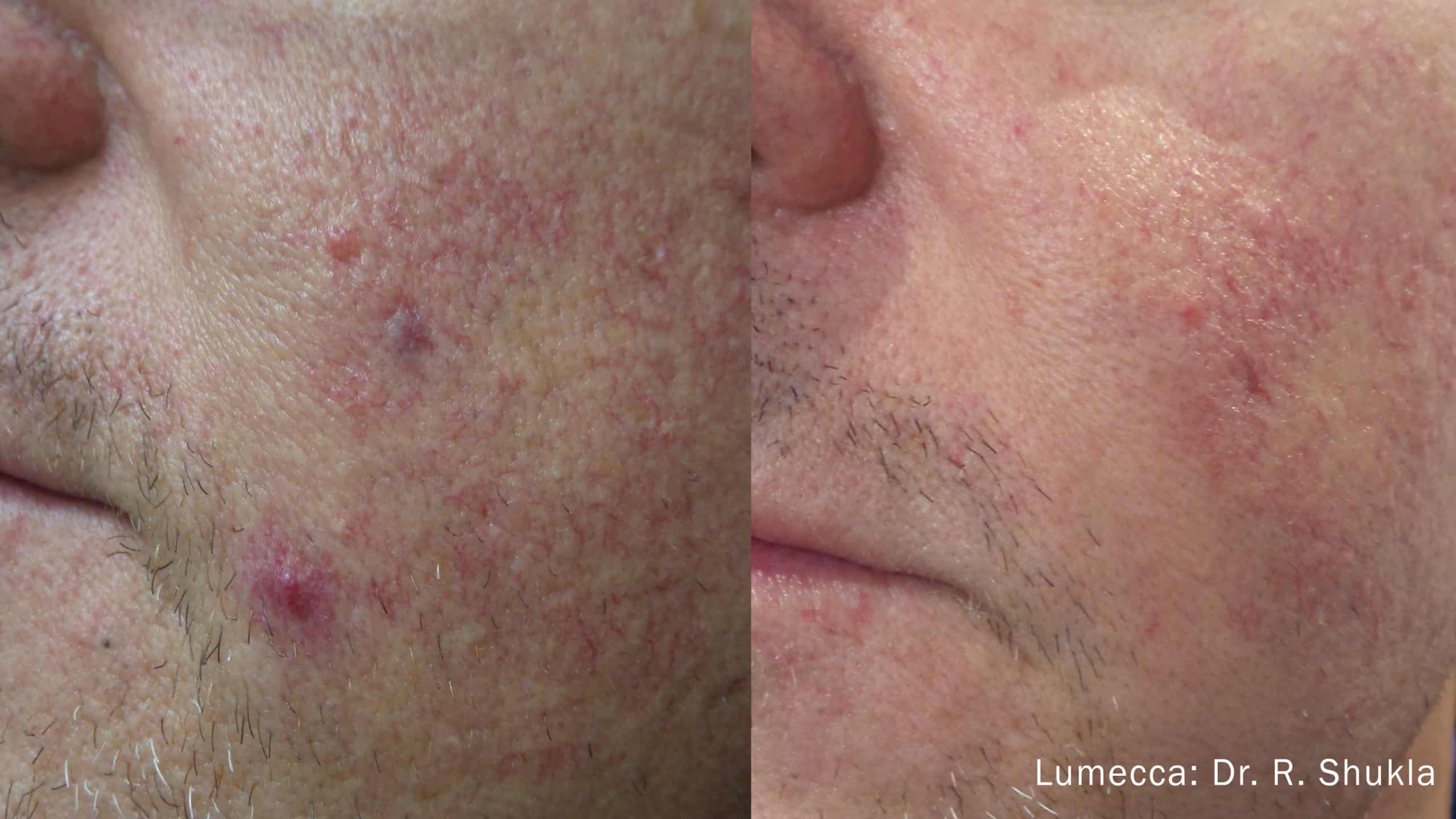 lumecca-before-after-dr-r-shukla-preview-3