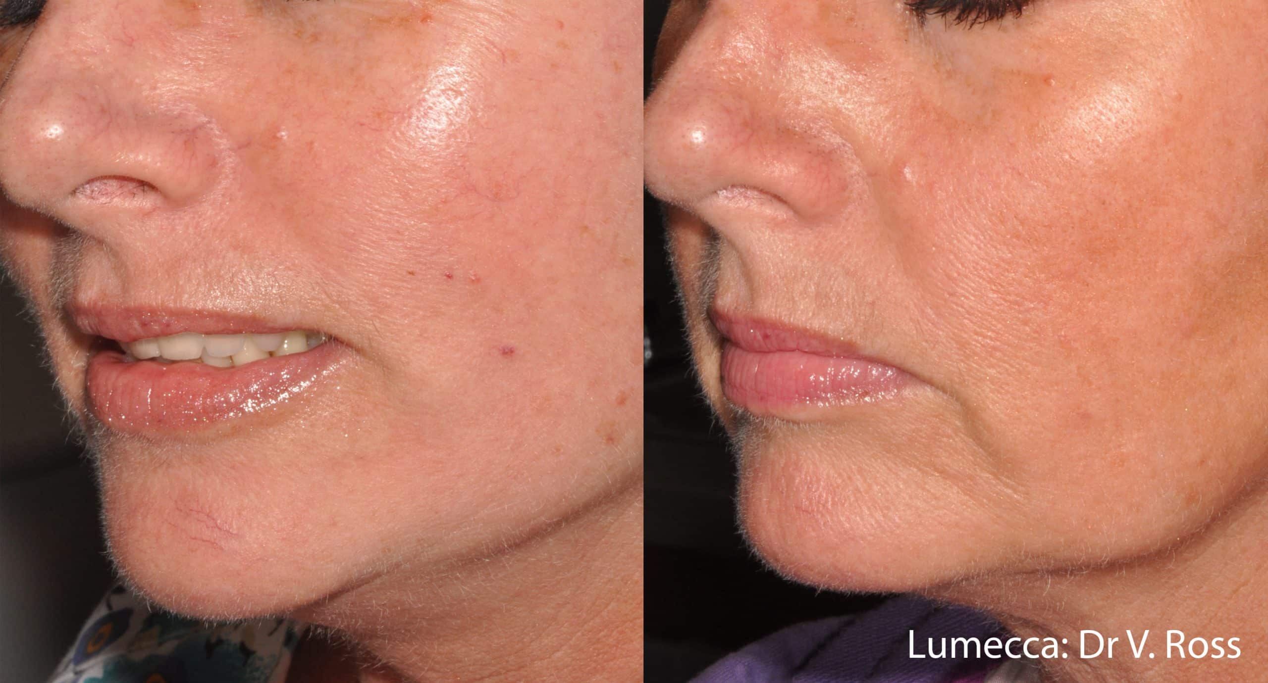 lumecca-before-after-dr-v-ross-preview-10