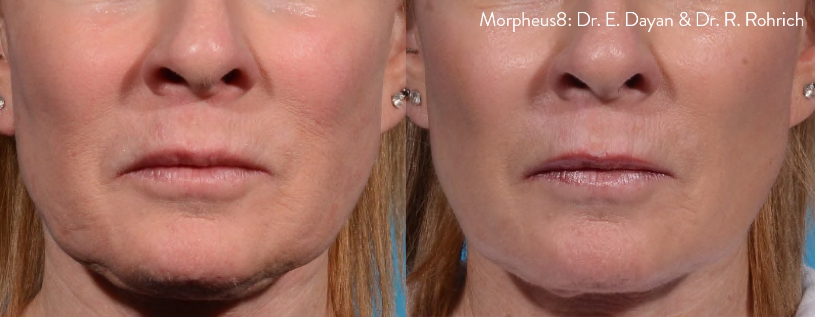 morpheus8-before-after-dr-e-dayan-dr-r-rohrich-preview-1