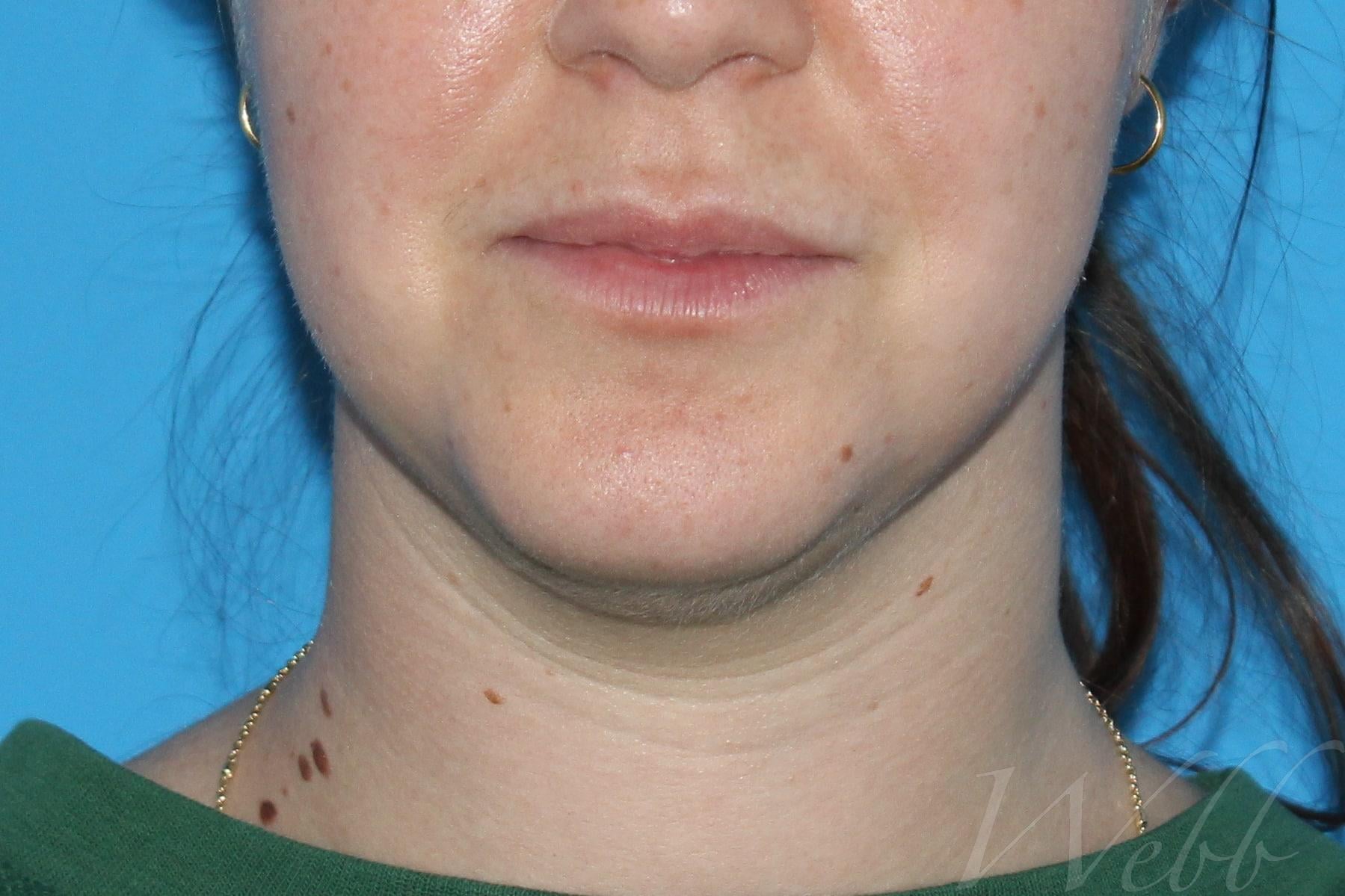 neck liposuction patient
