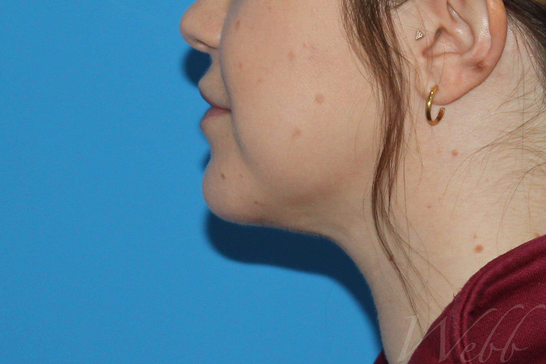 neck liposuction patient