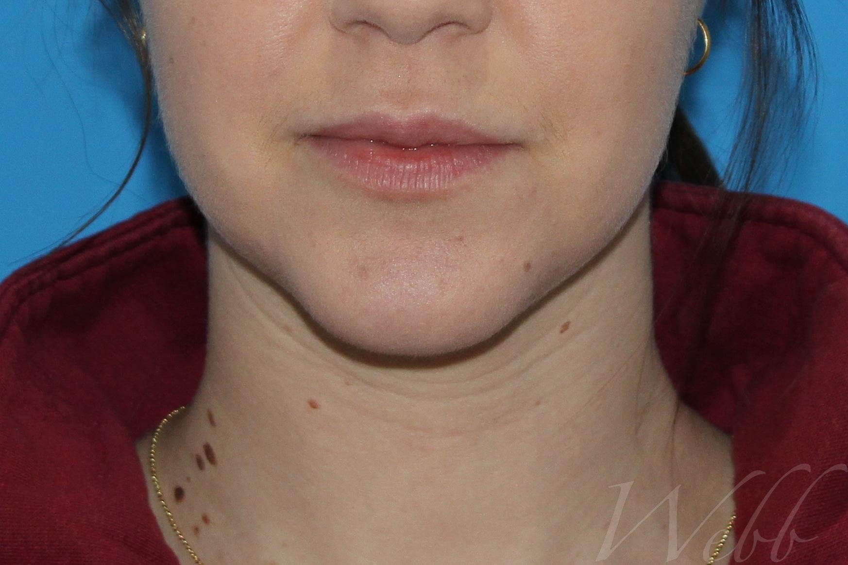 neck liposuction patient