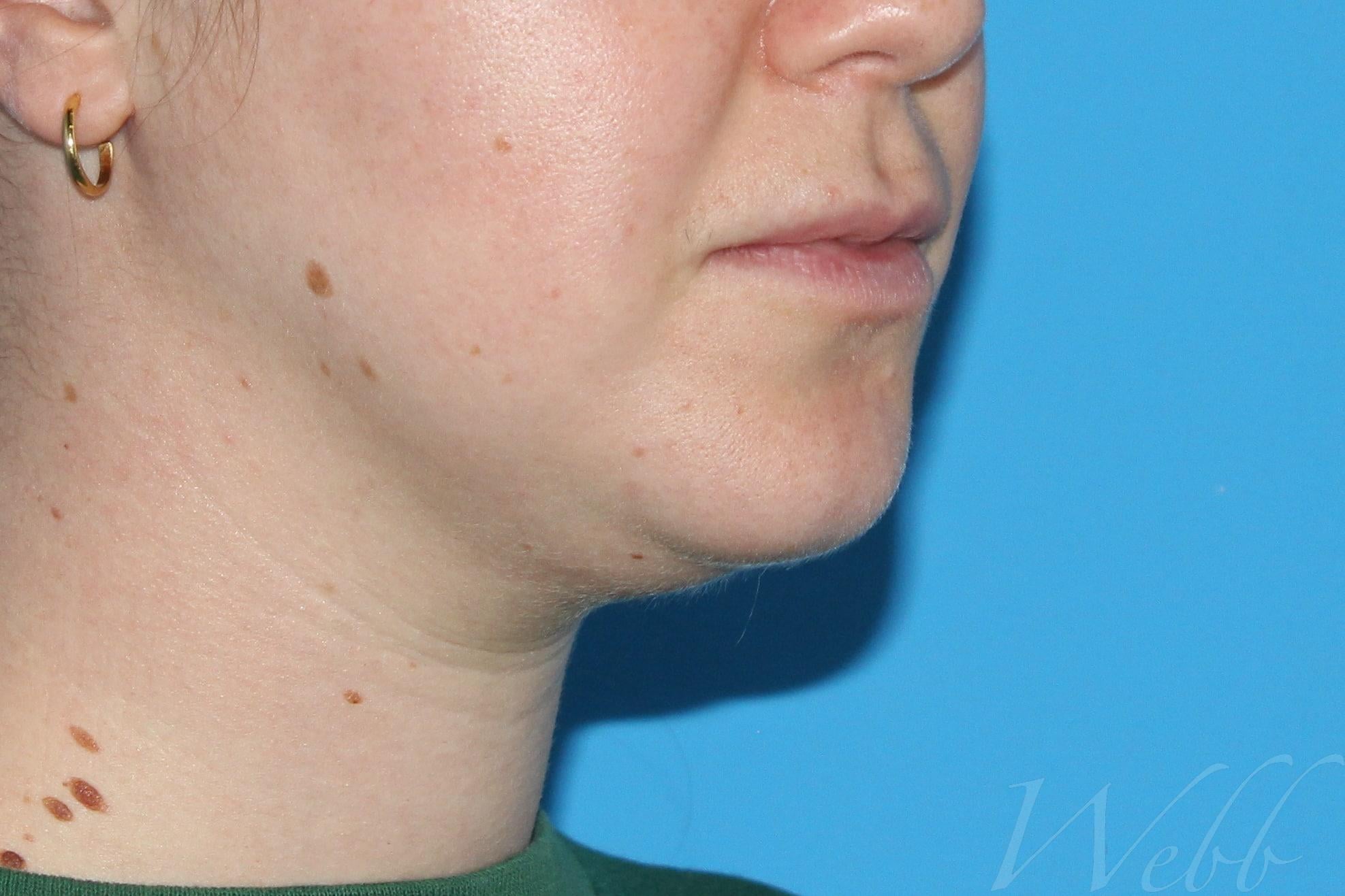 neck liposuction patient