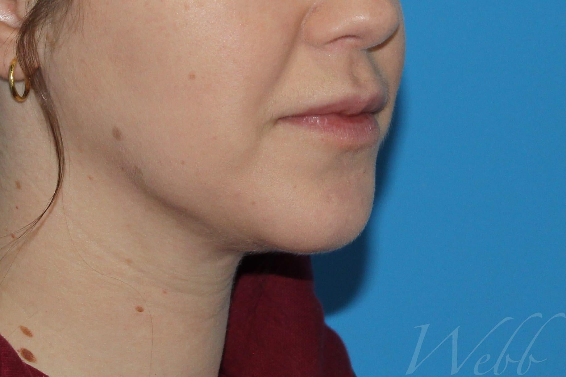 neck liposuction patient