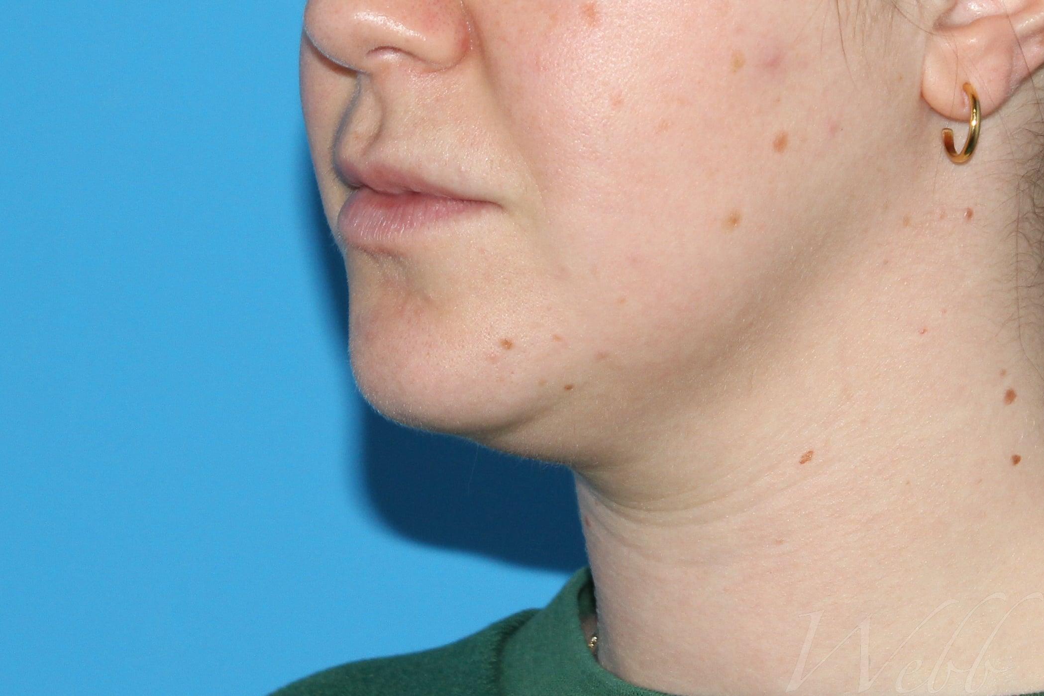 neck liposuction patient