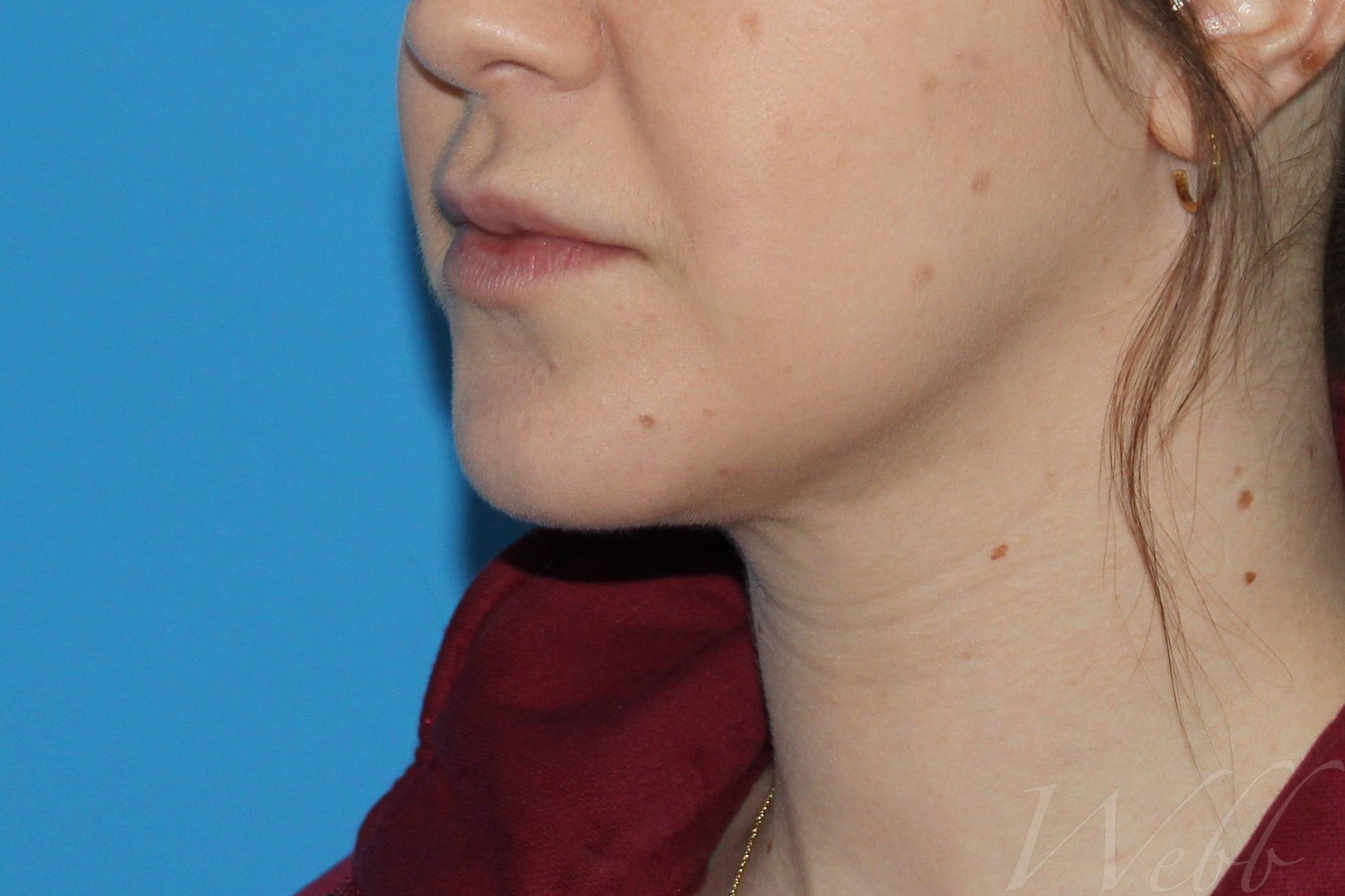 neck liposuction patient