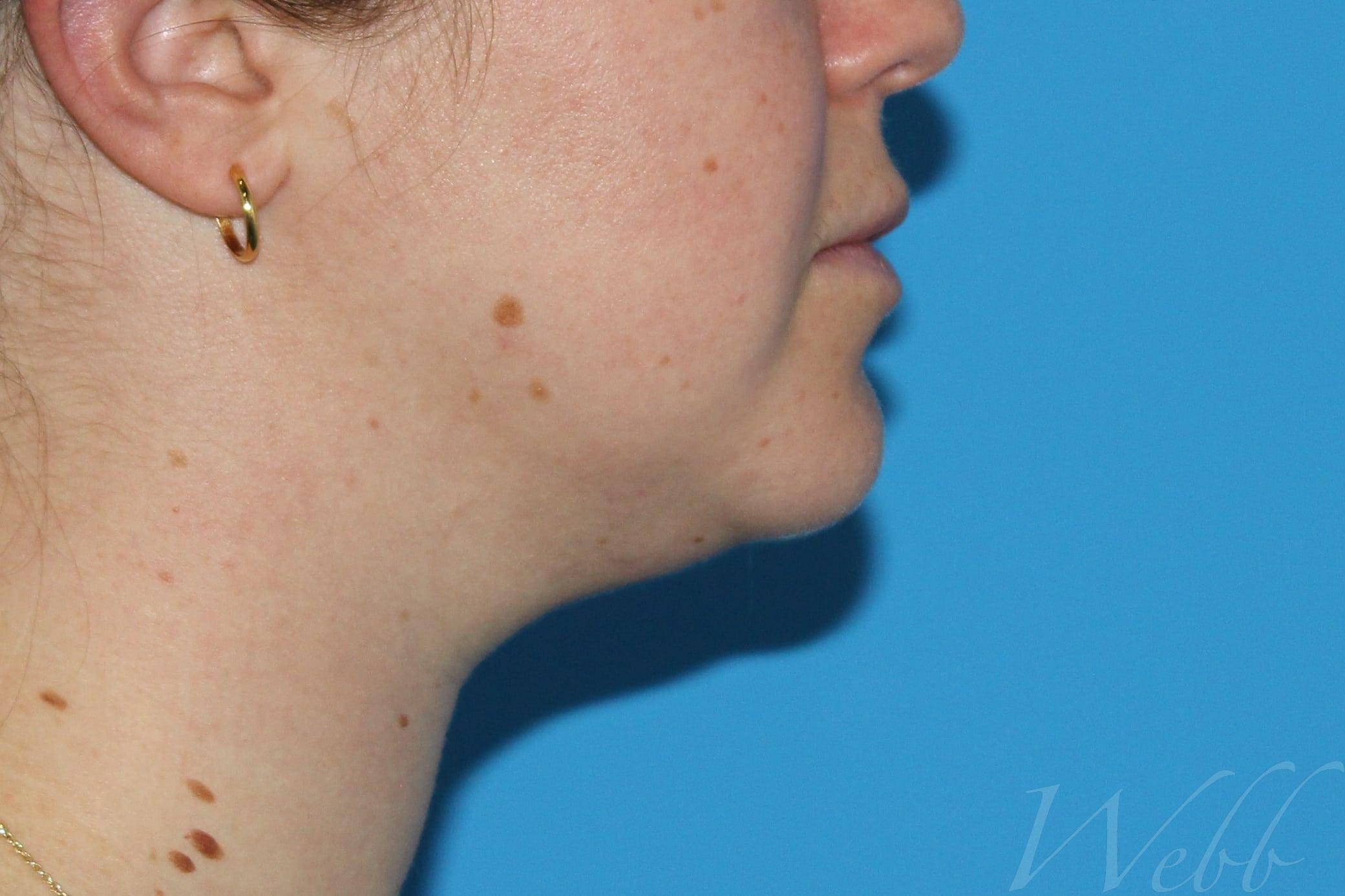 neck liposuction patient