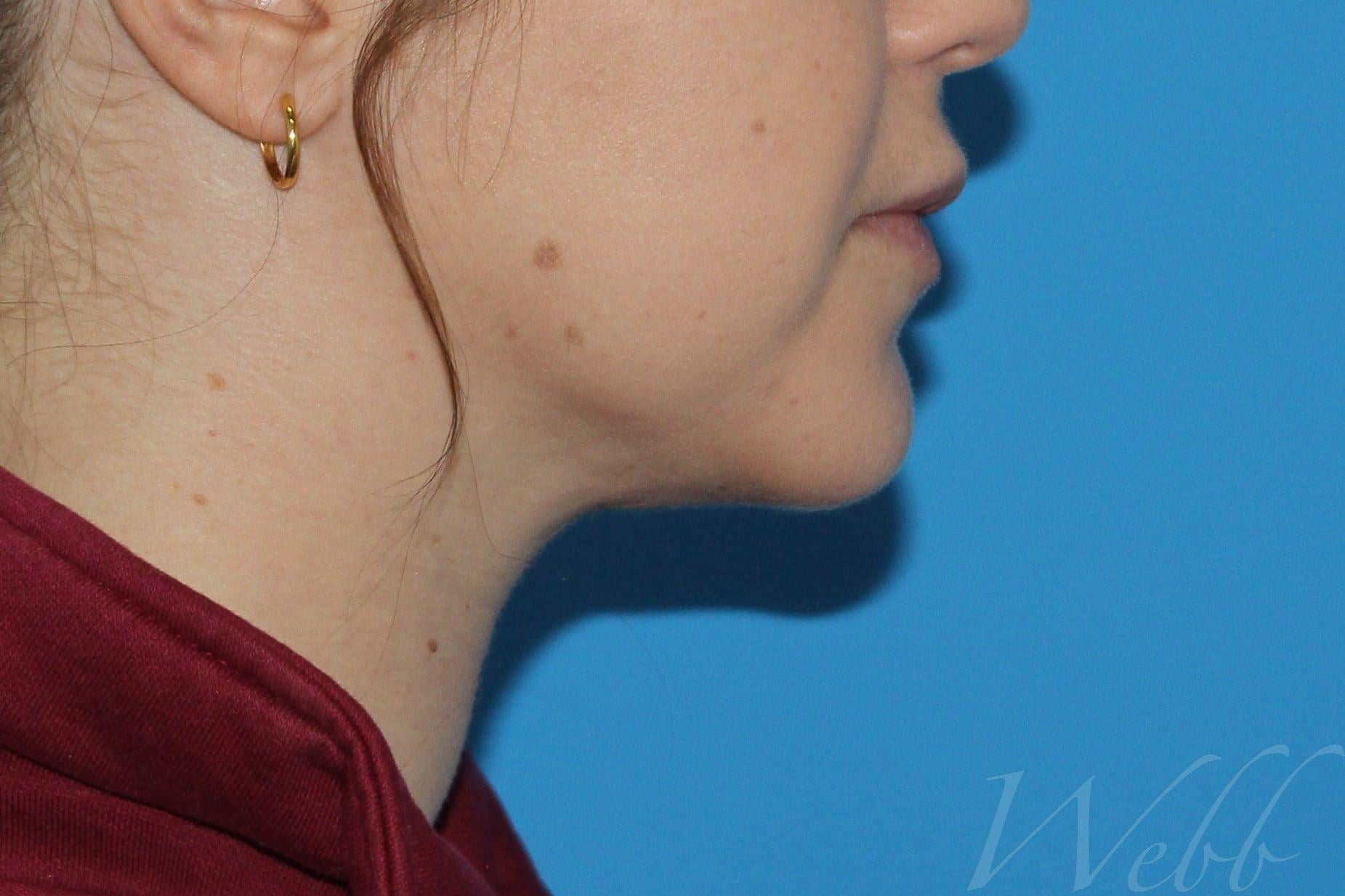 neck liposuction patient