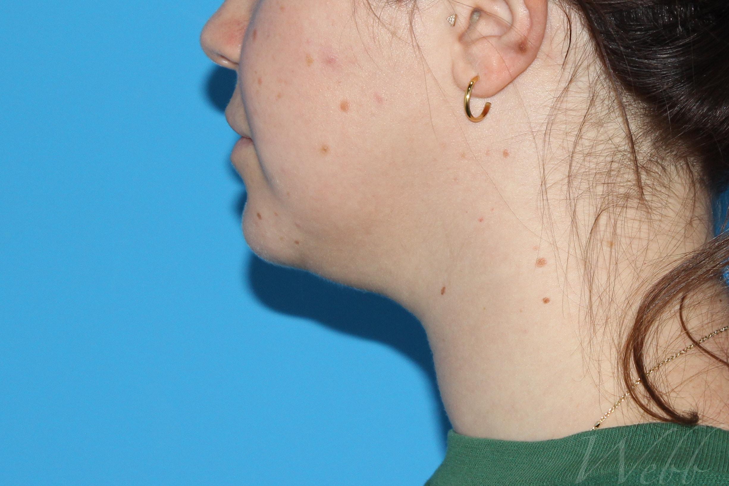 neck liposuction patient