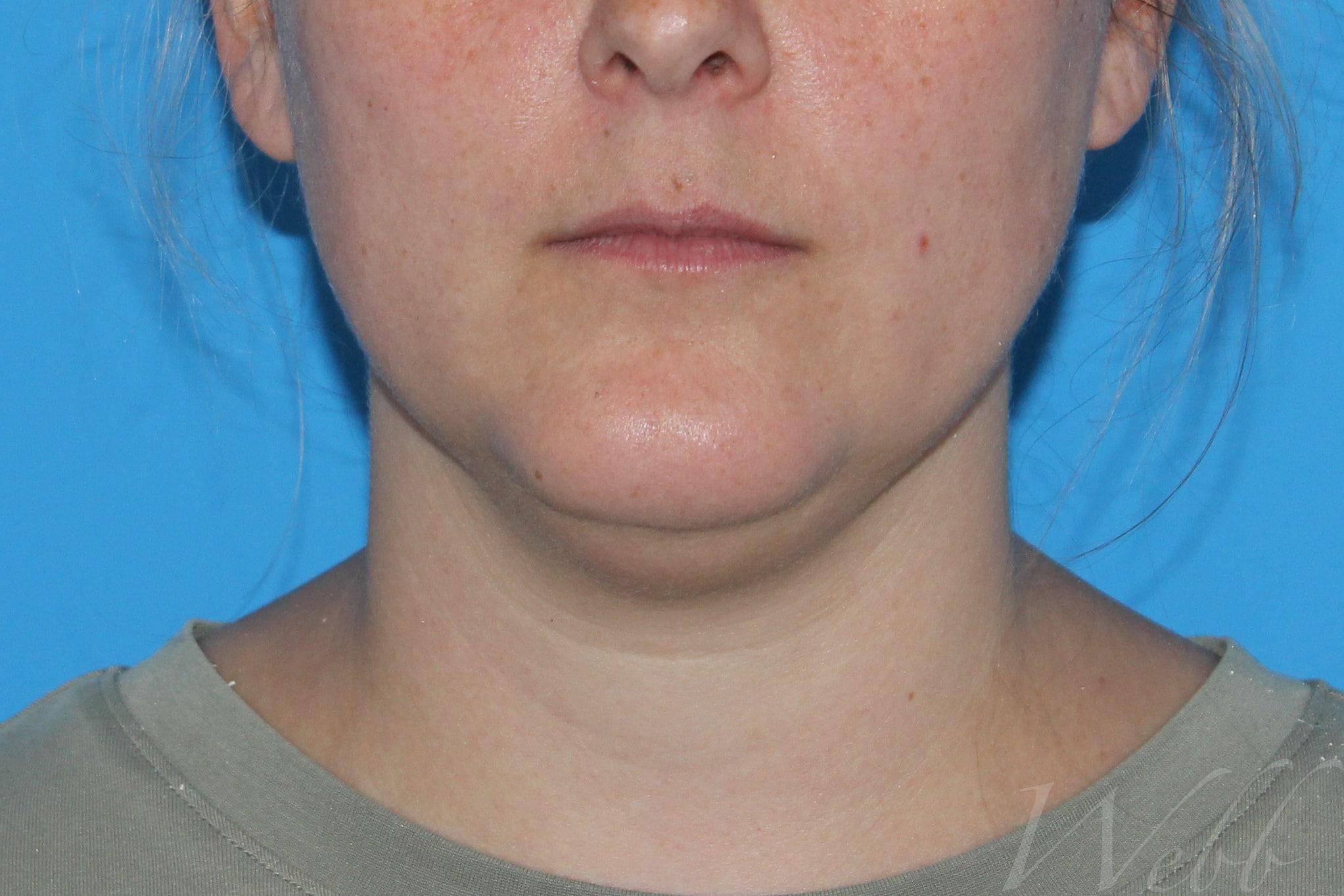neck liposuction patient