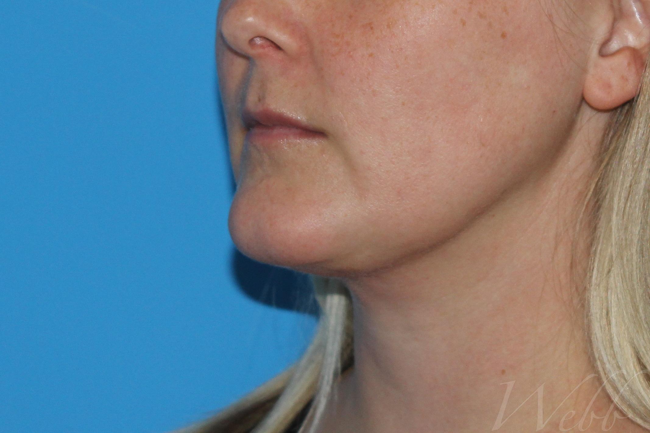 neck liposuction patient