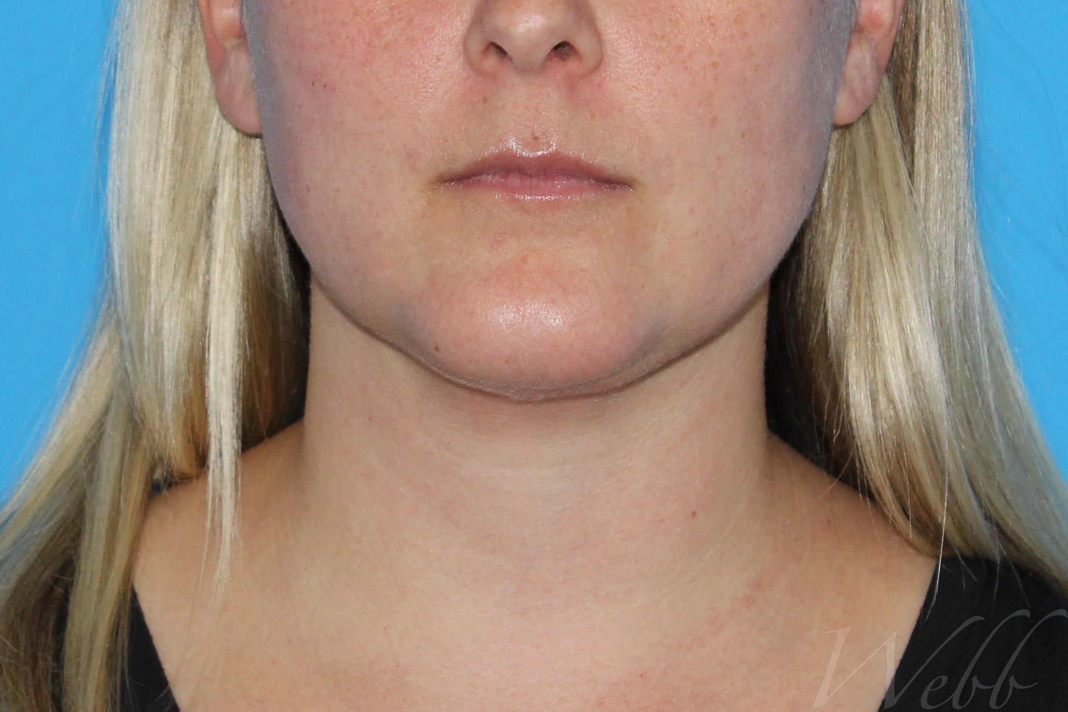 neck liposuction patient