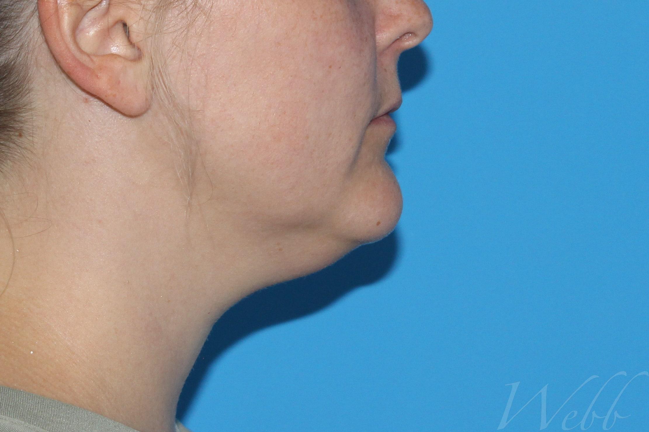 neck liposuction patient