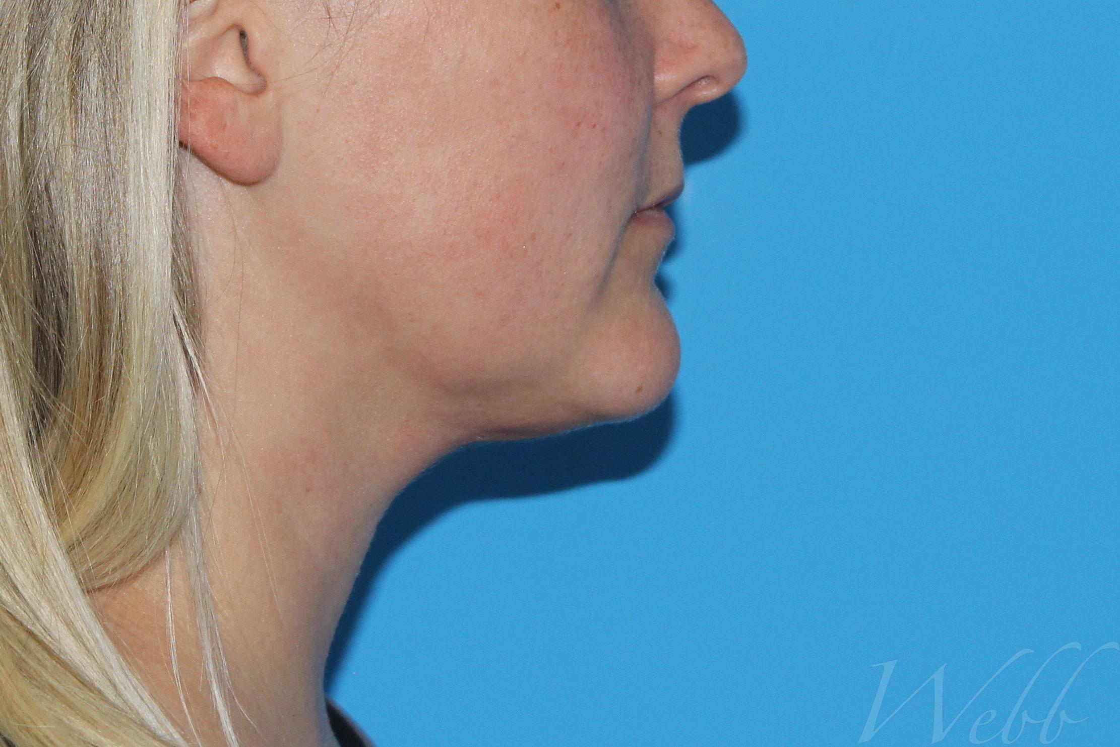 neck liposuction patient