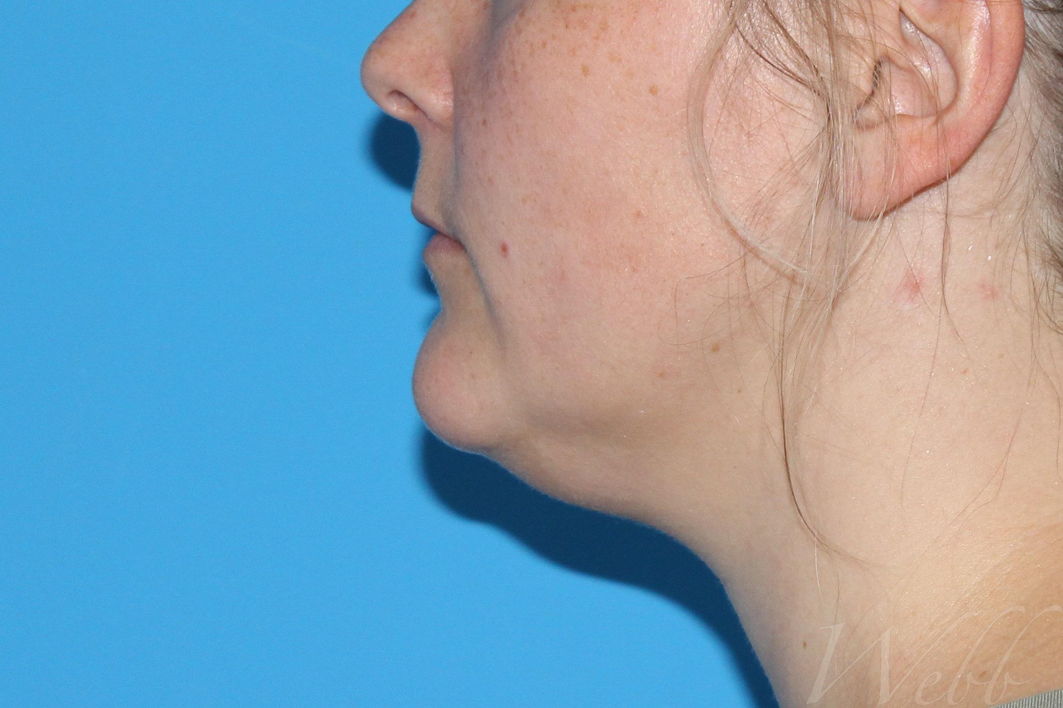 neck liposuction patient