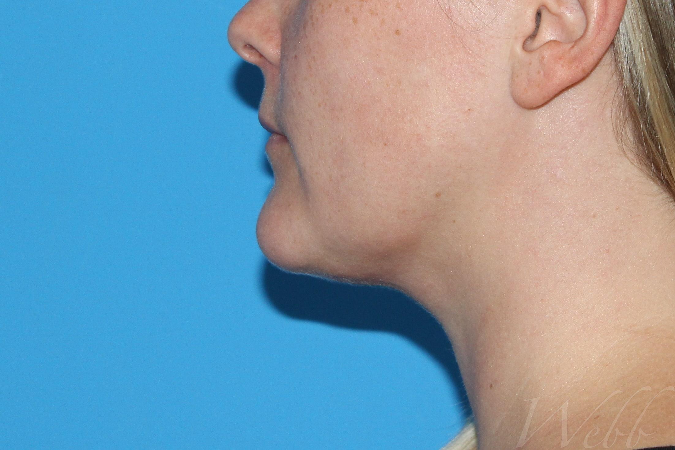 neck liposuction patient