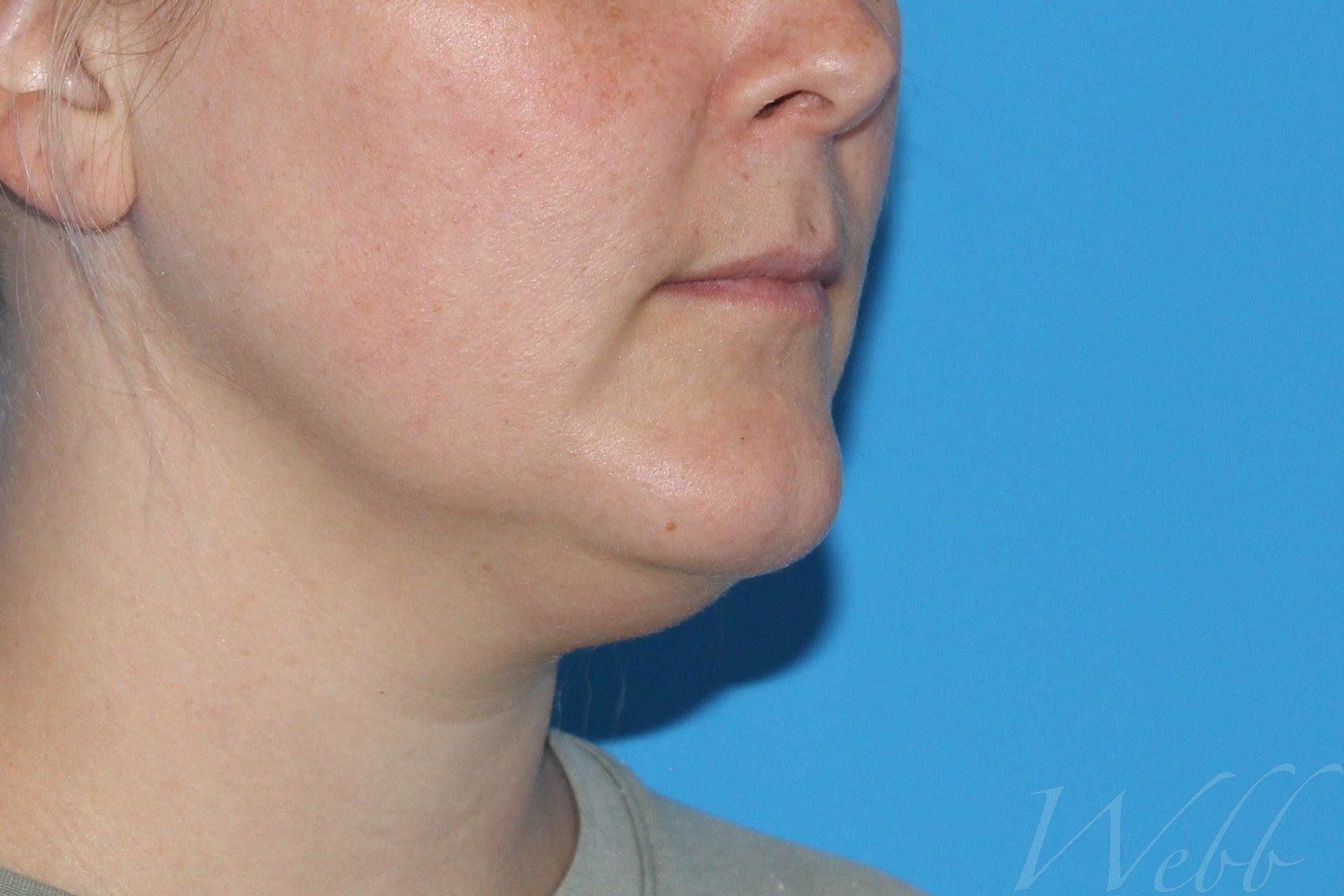 neck liposuction patient