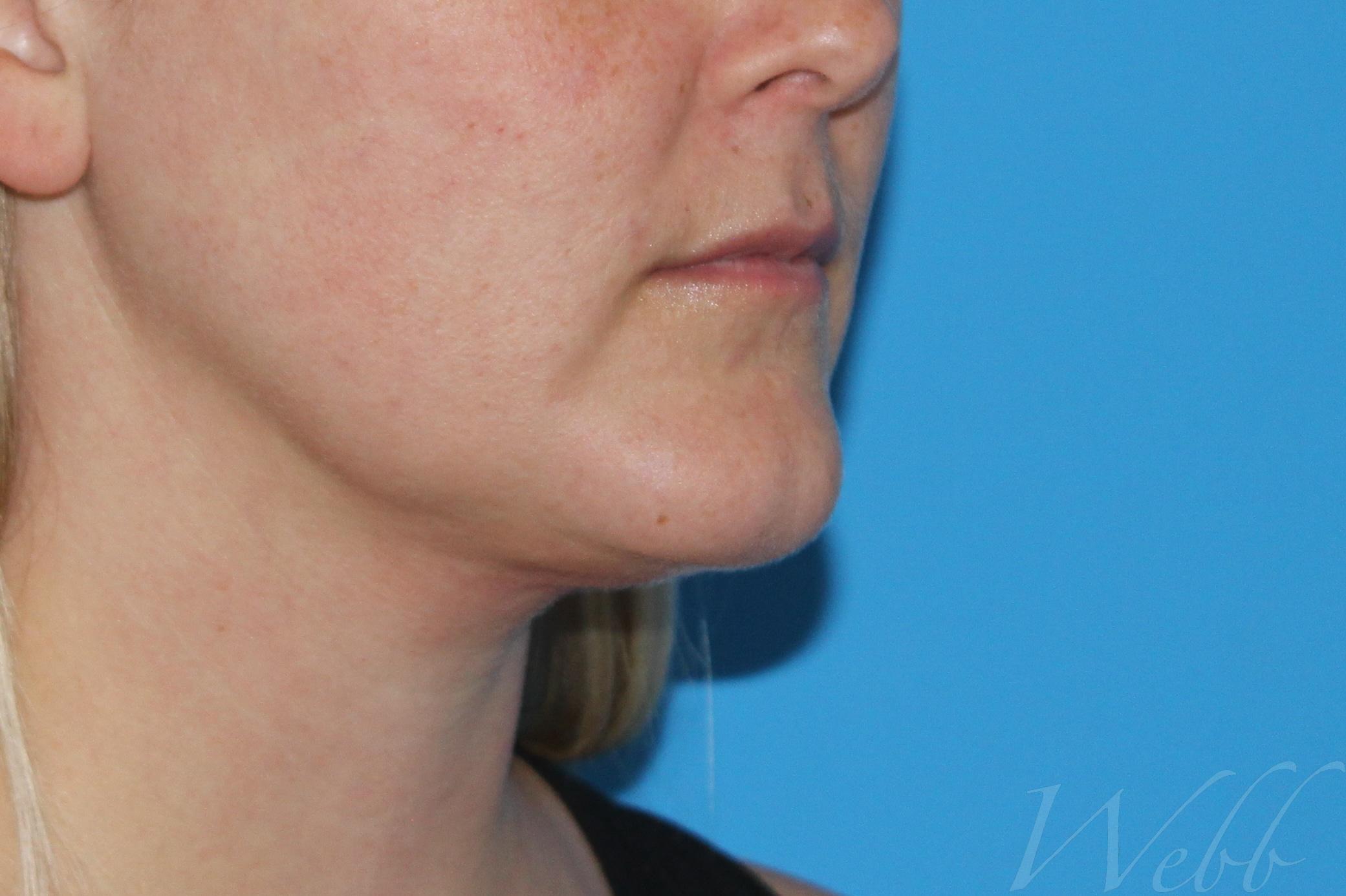 neck liposuction patient