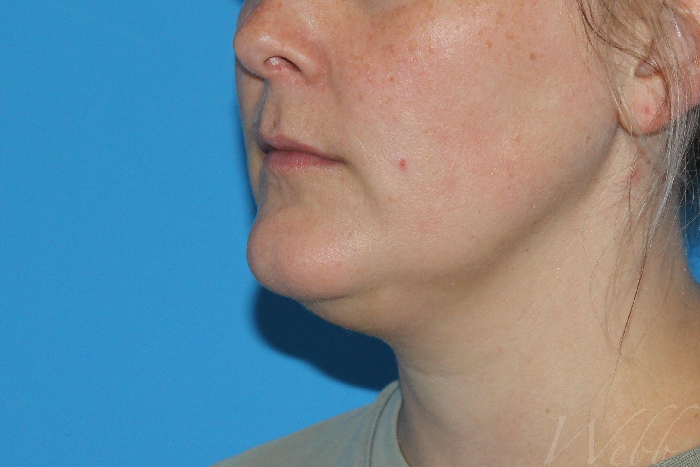 neck liposuction patient