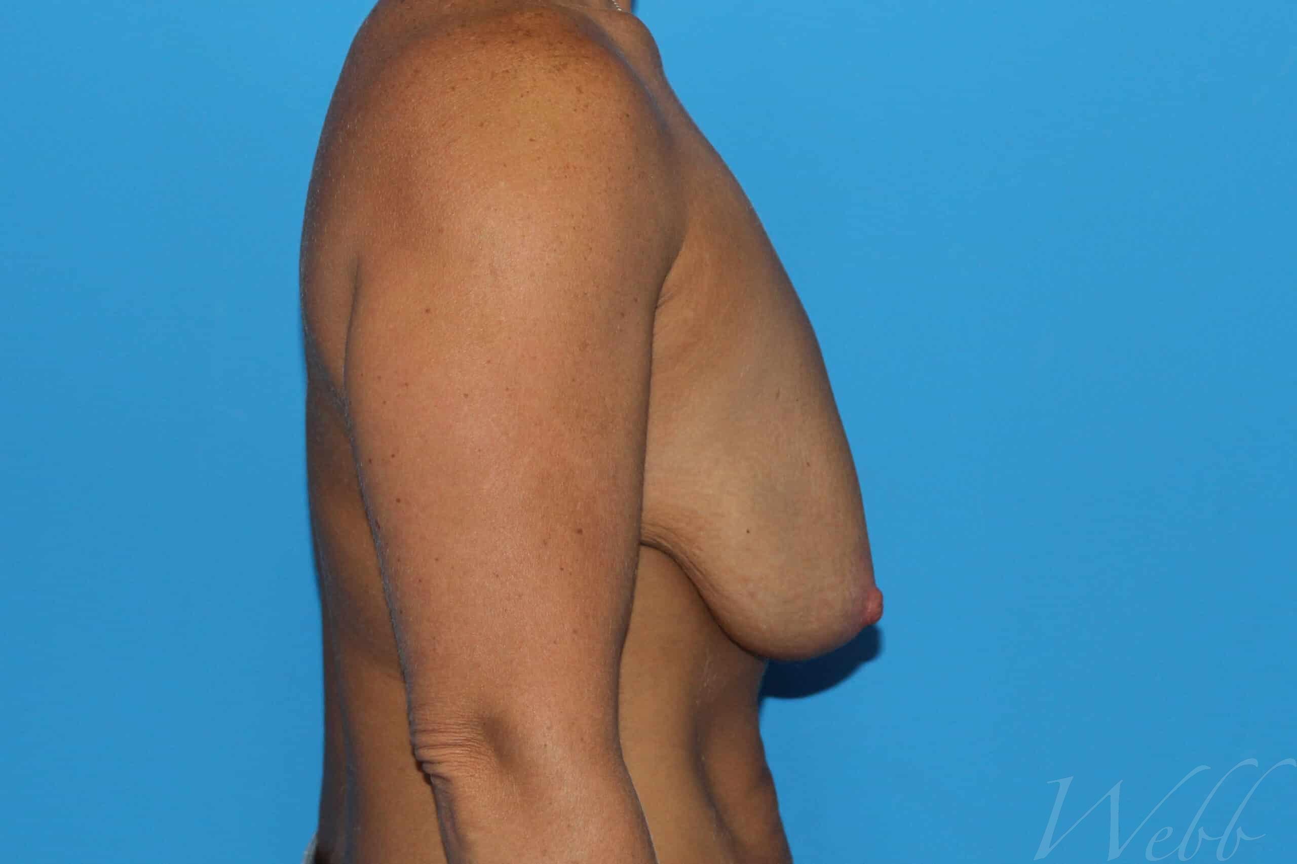 breast reduction patient