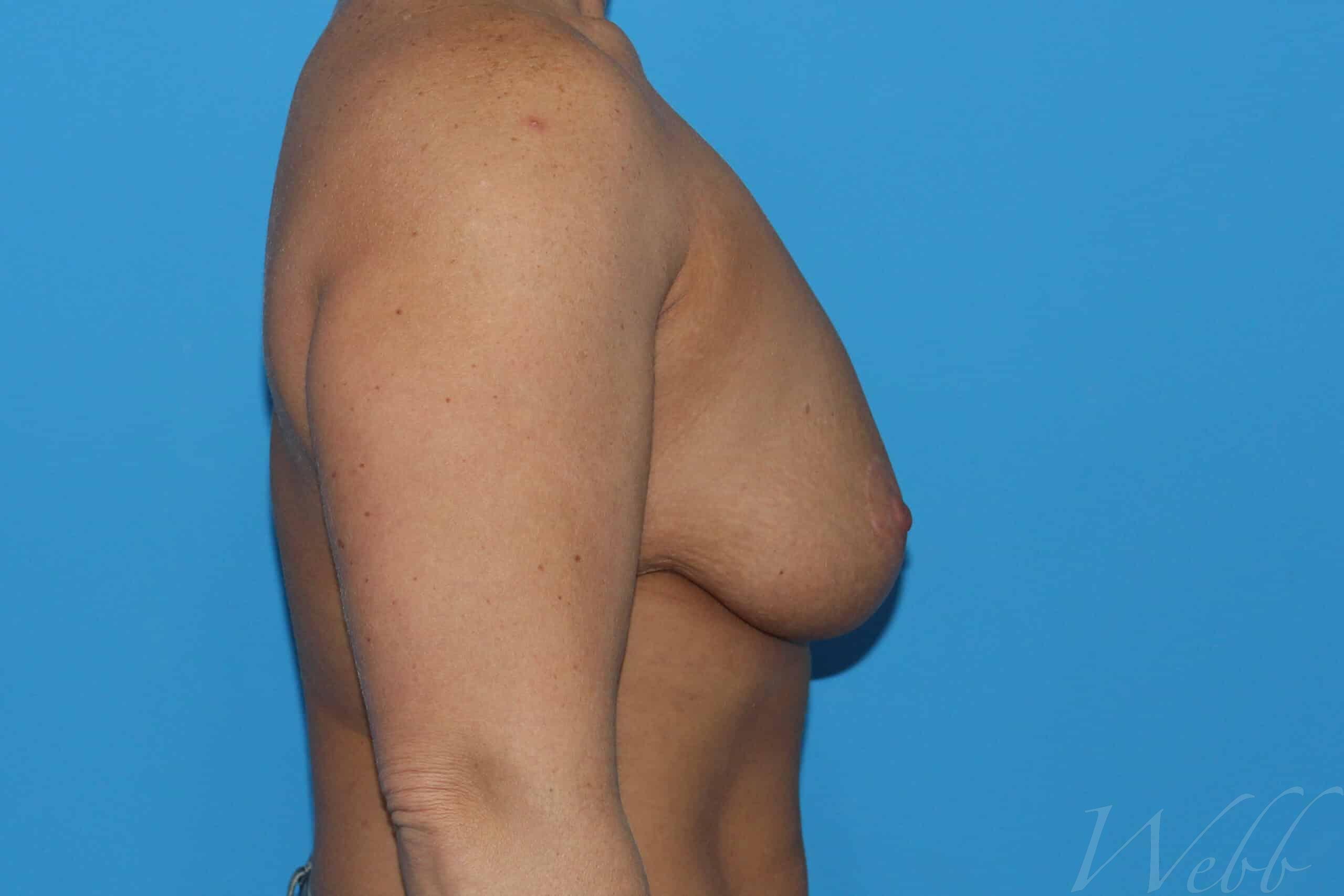 breast reduction patient