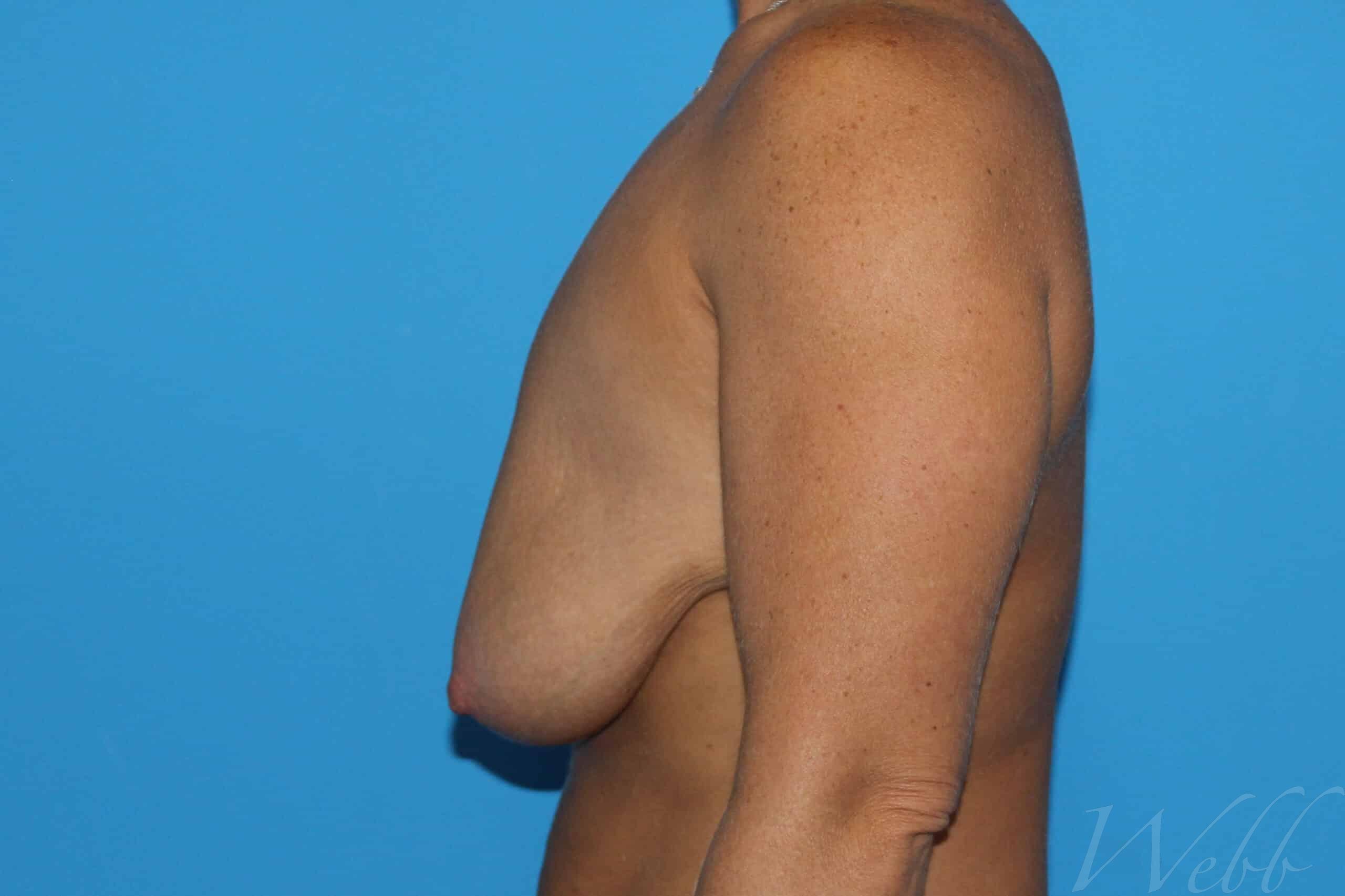 breast reduction patient