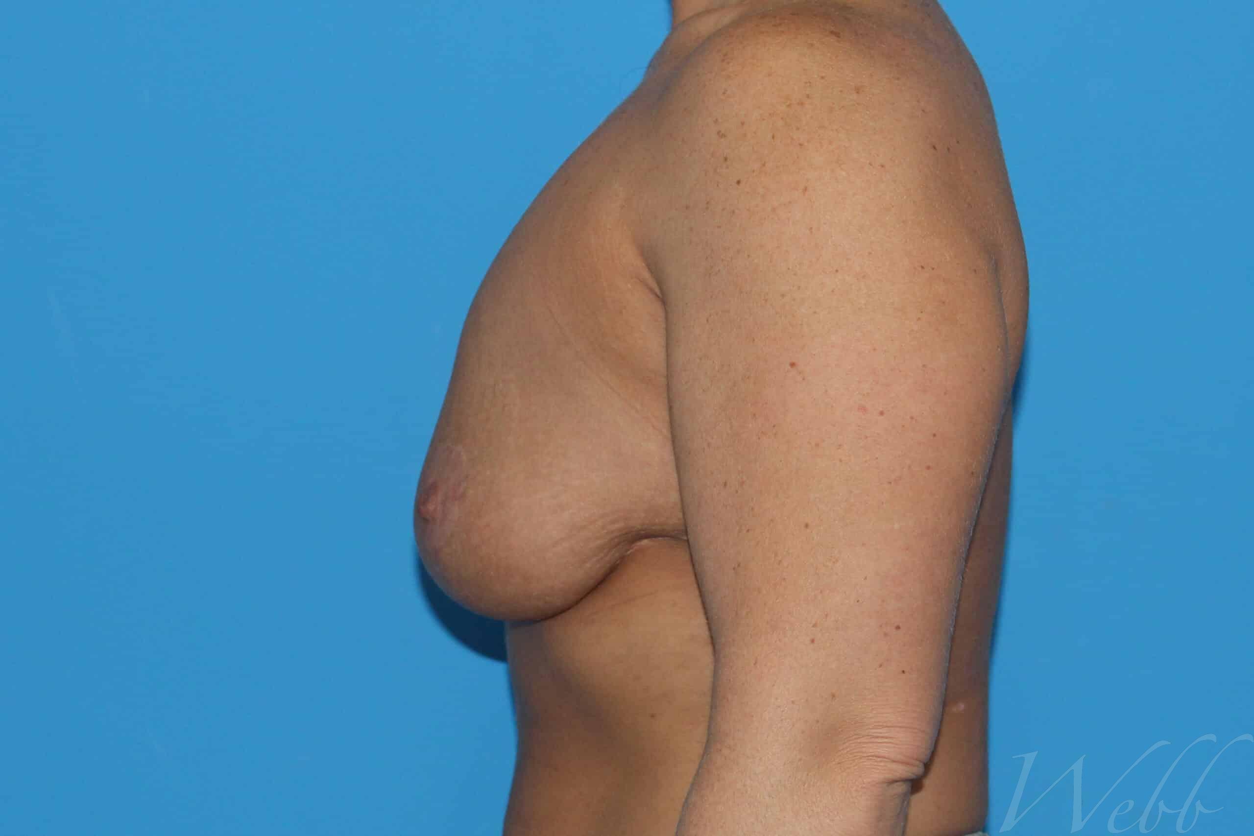 breast reduction patient