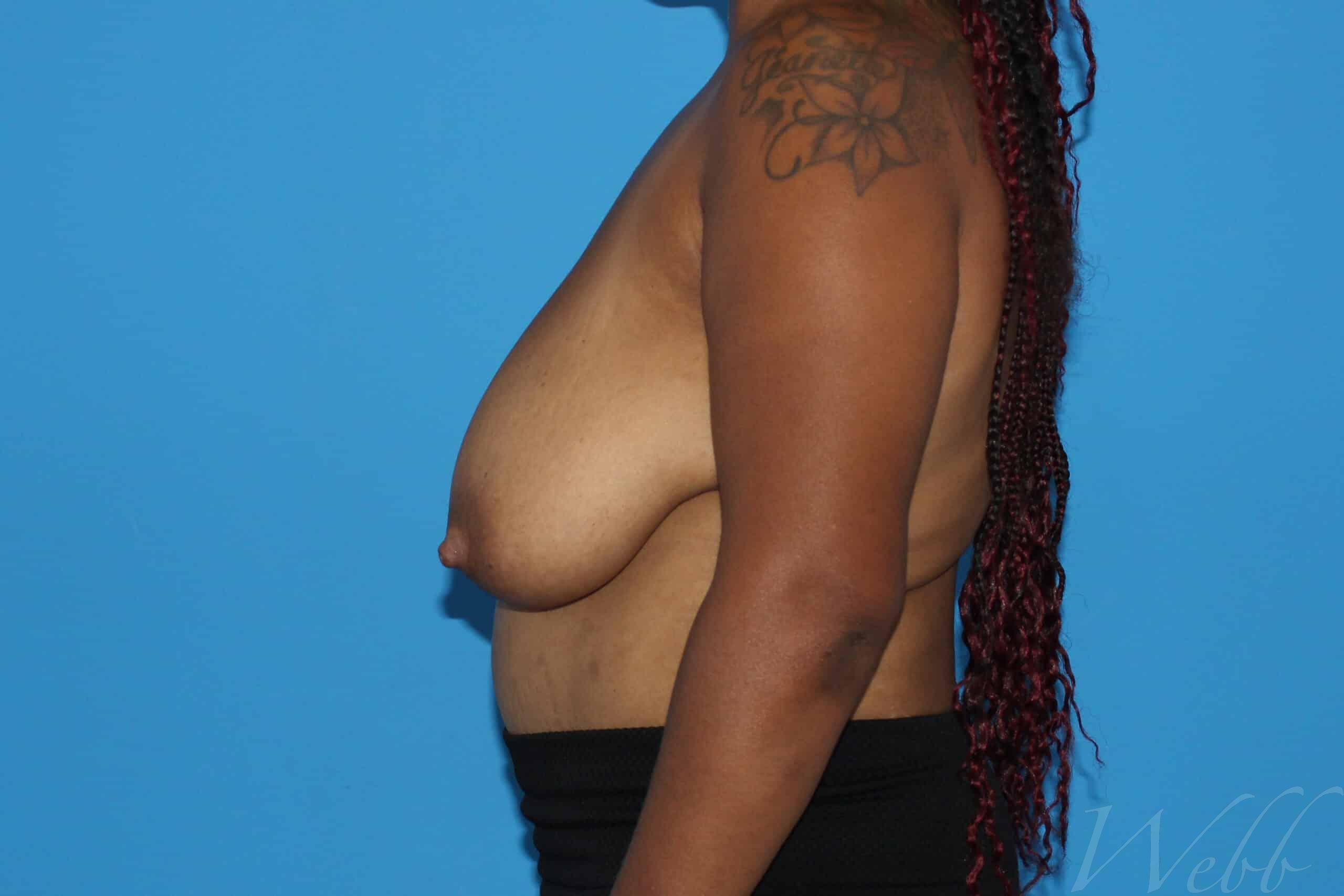 breast reduction patient