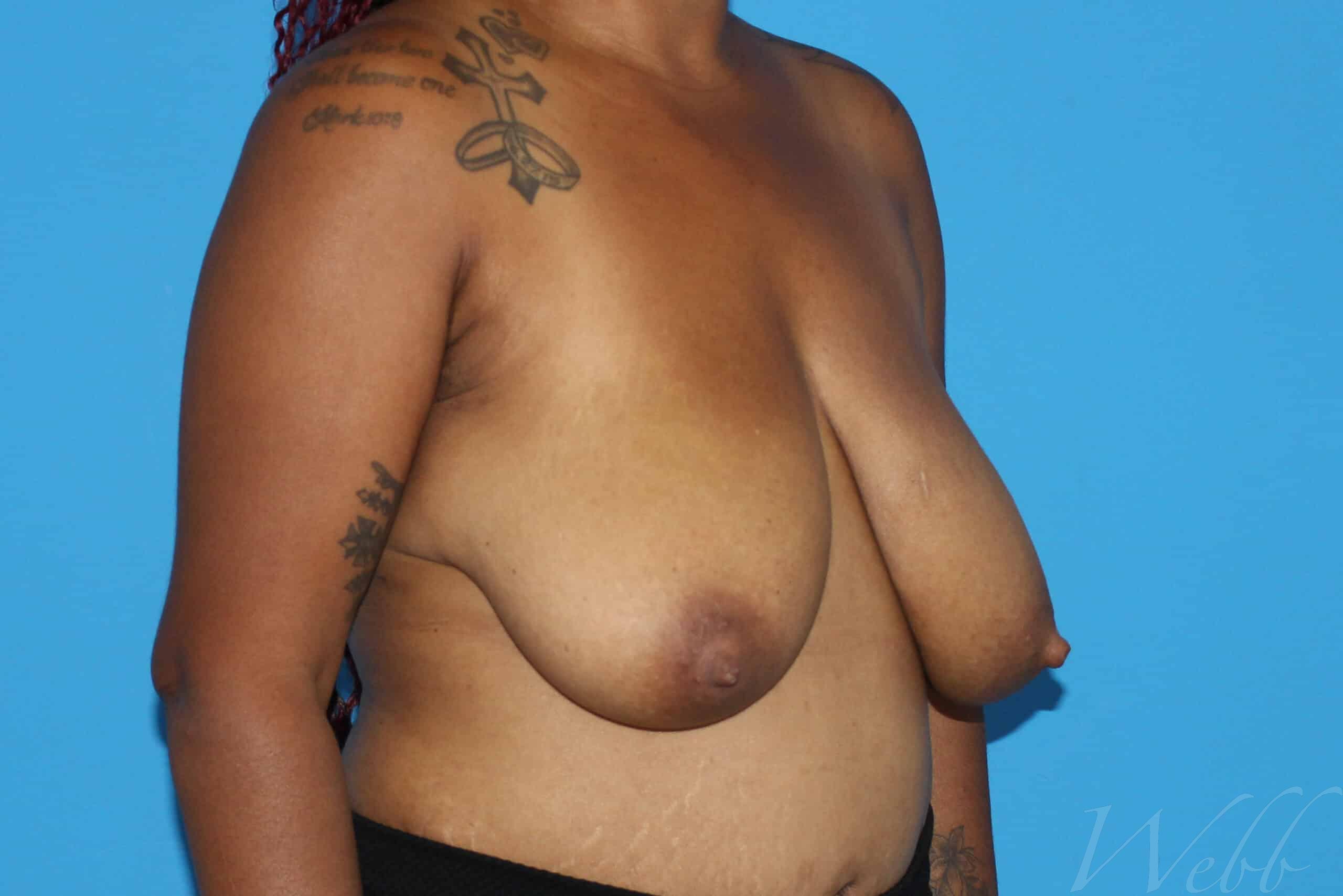 breast reduction patient
