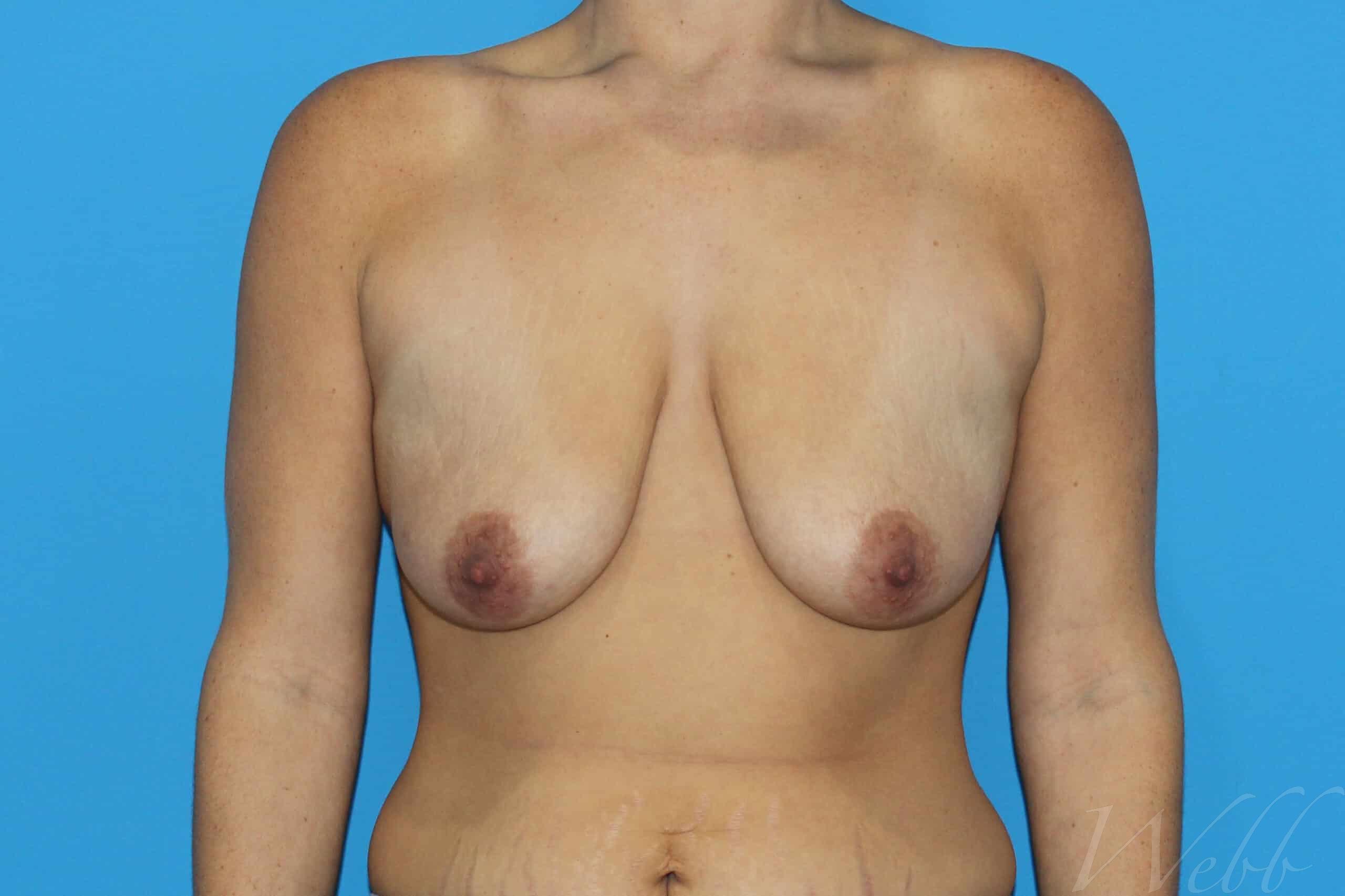 breast reduction patient