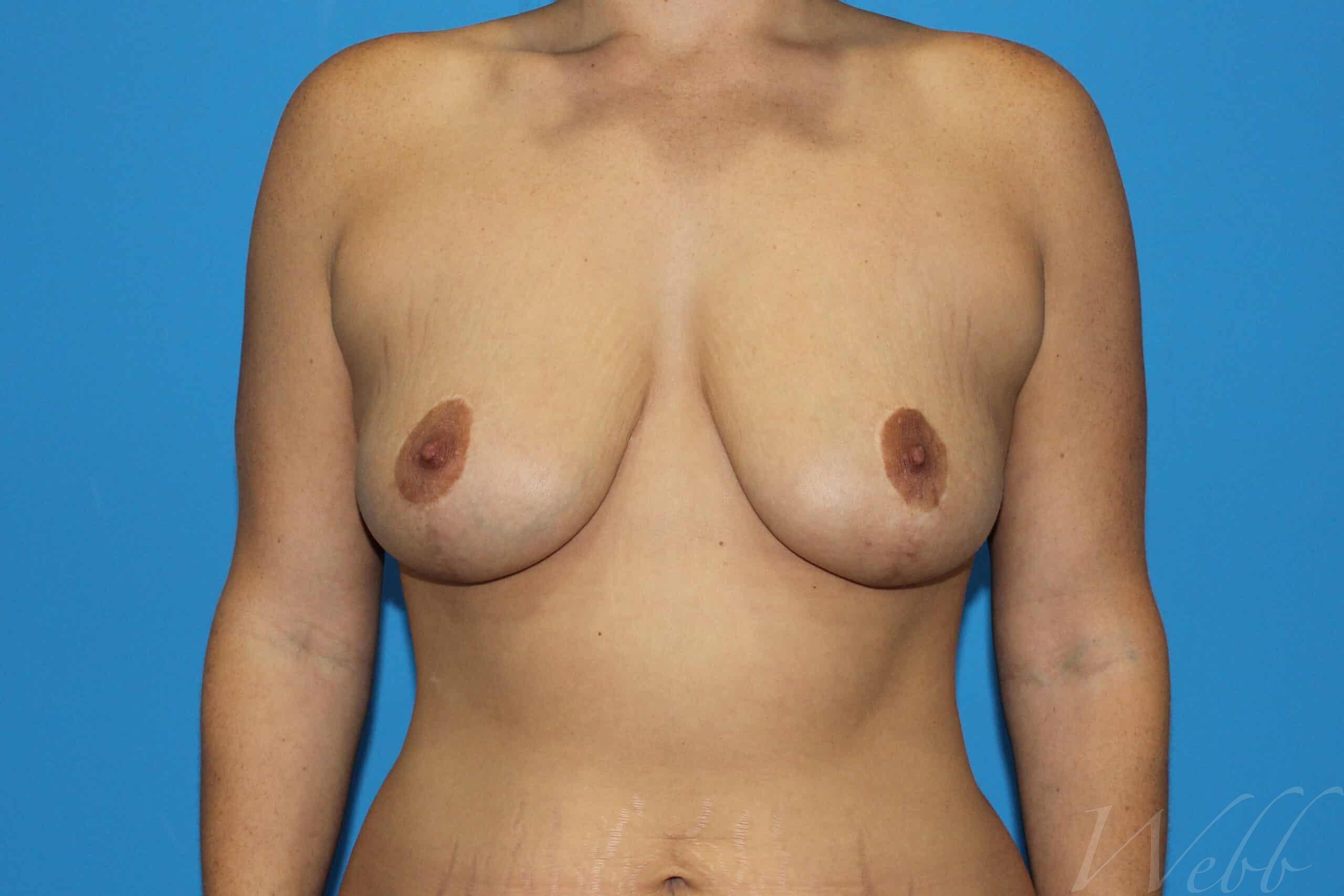 breast reduction patient