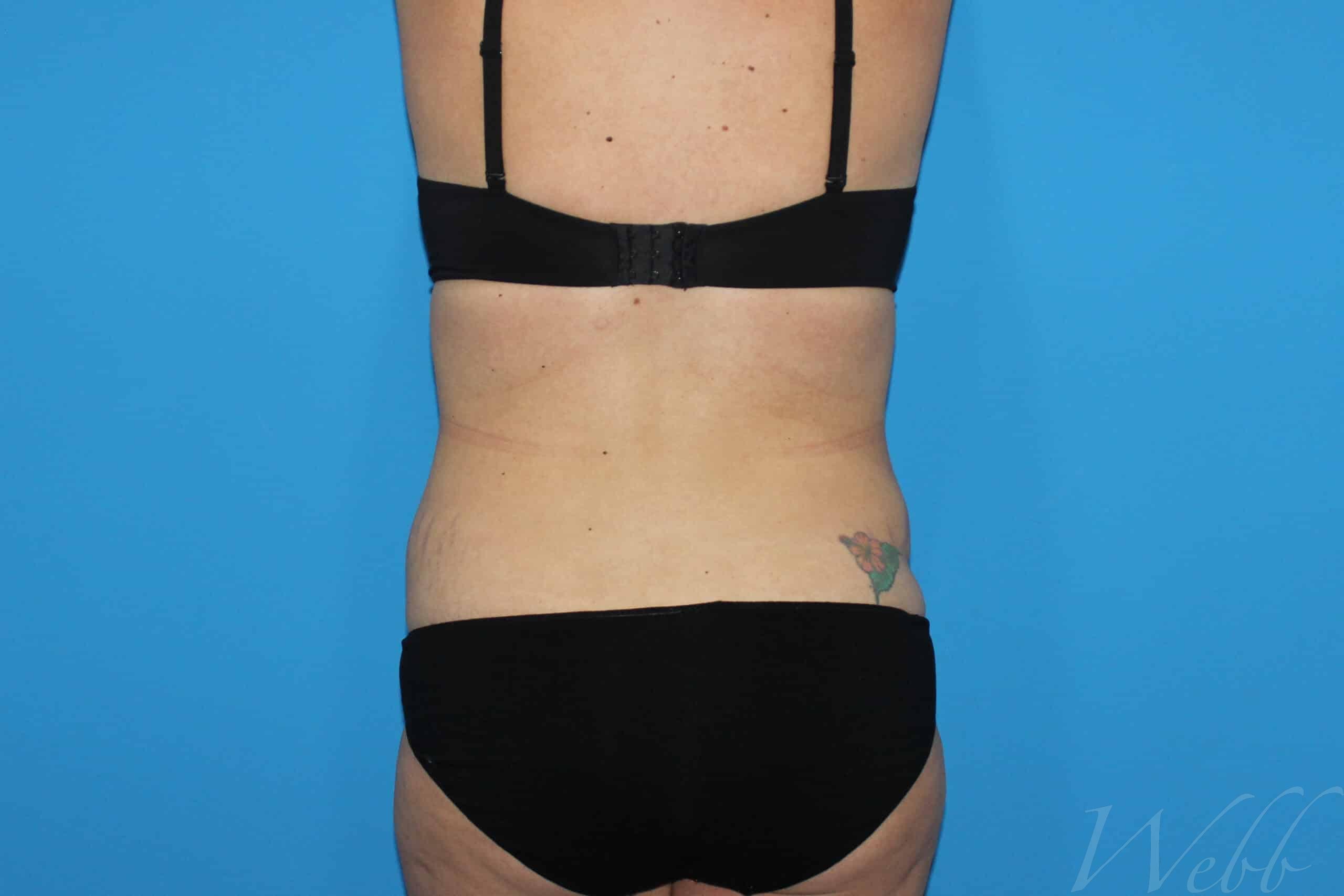 tummy tuck patient