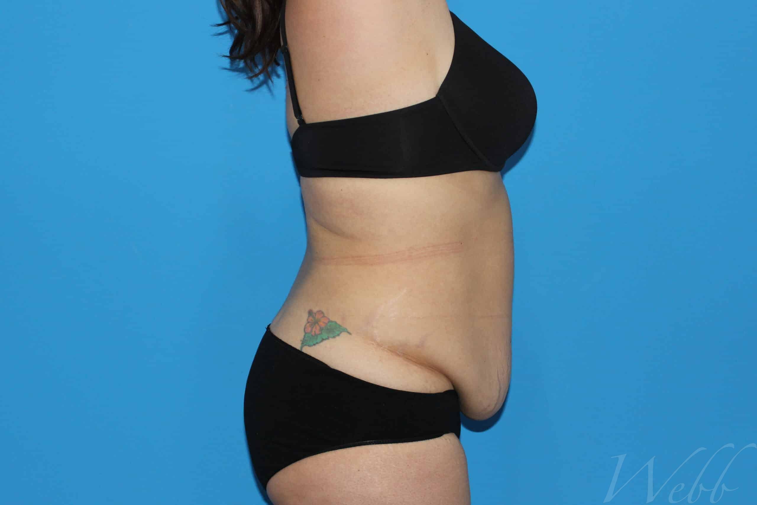 tummy tuck patient