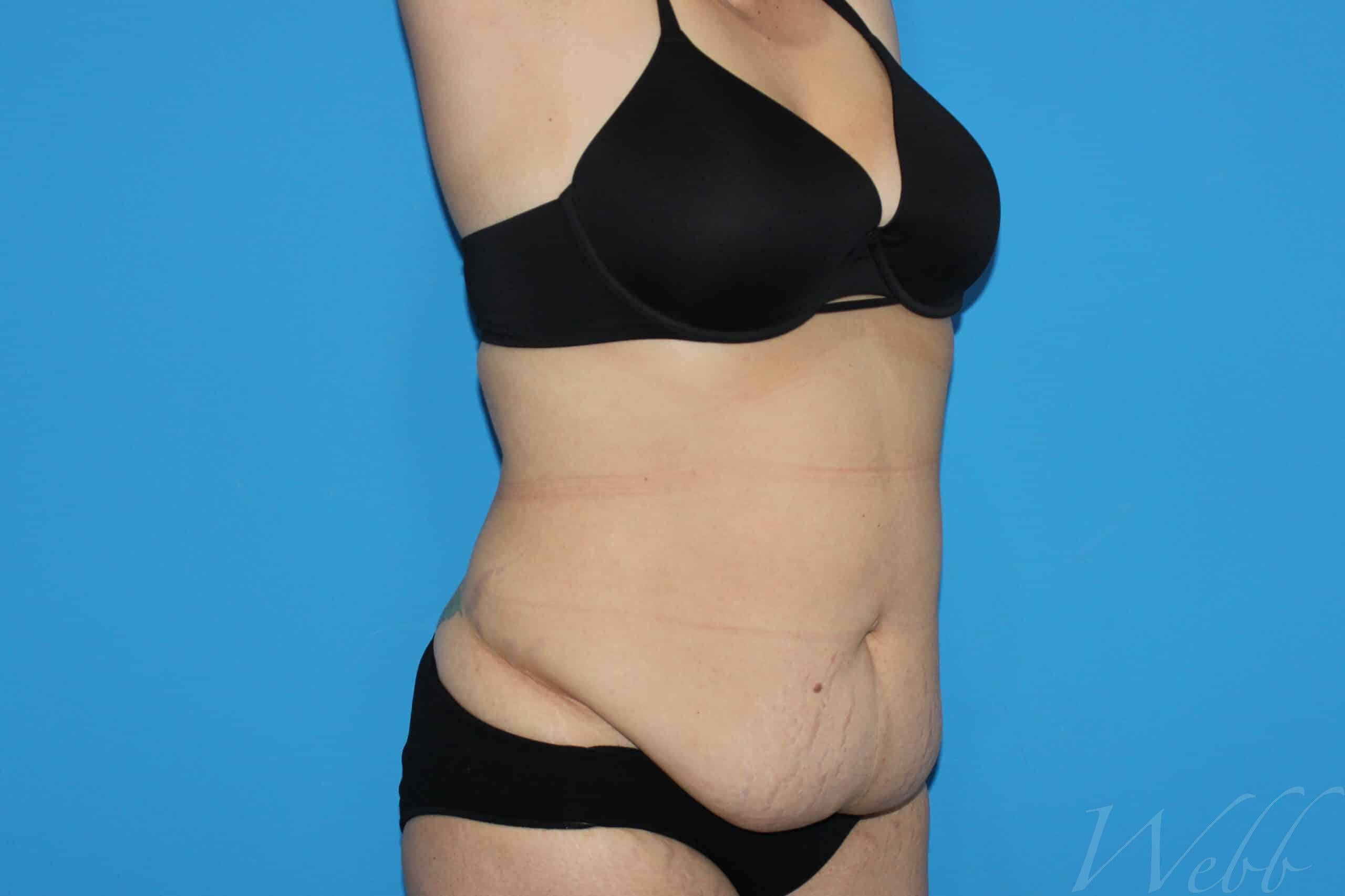 tummy tuck patient
